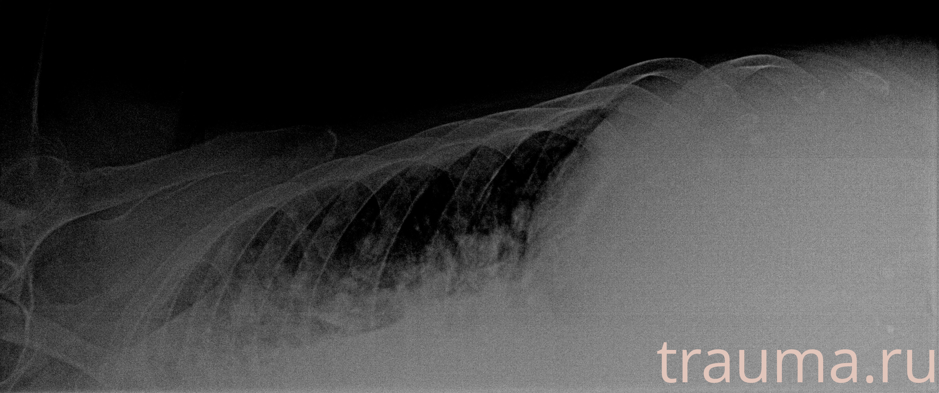 Рентген на дому: по вашему адресу приезжает врач-рентгенолог, травматолог-ортопед с мобильным рентгеновским аппаратом, проводит диагностику травмы или заболевания, делает необходимые рентгенограммы, дает рекомендации по дальнейшему лечению. Получить качественные снимки в домашних условиях возможно благодаря уникальной методике, разработанной МосРентген Центром для института  Склифосовского