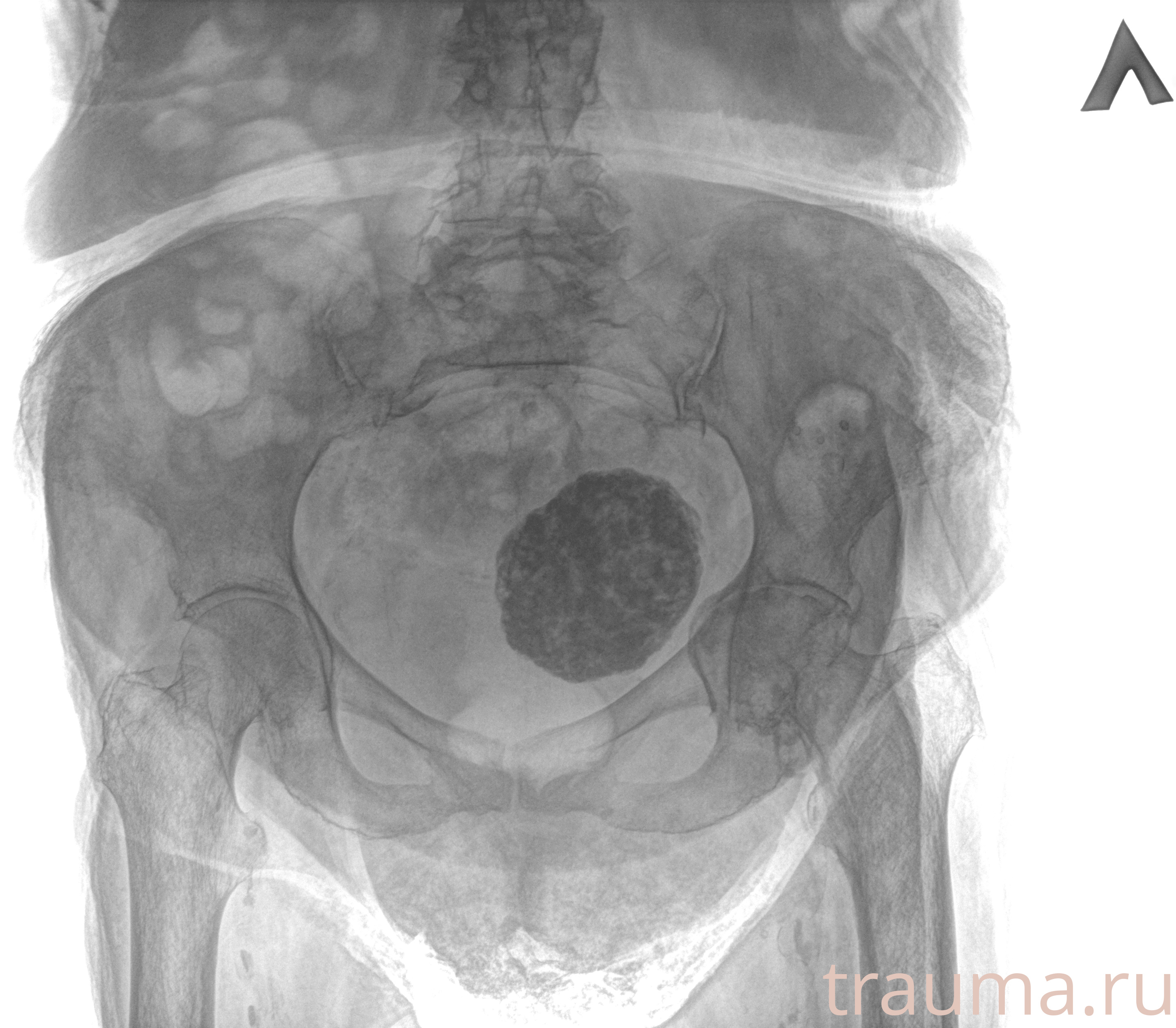 Рентген на дому: по вашему адресу приезжает врач-рентгенолог, травматолог-ортопед с мобильным рентгеновским аппаратом, проводит диагностику травмы или заболевания, делает необходимые рентгенограммы, дает рекомендации по дальнейшему лечению. Получить качественные снимки в домашних условиях возможно благодаря уникальной методике, разработанной МосРентген Центром для института  Склифосовского