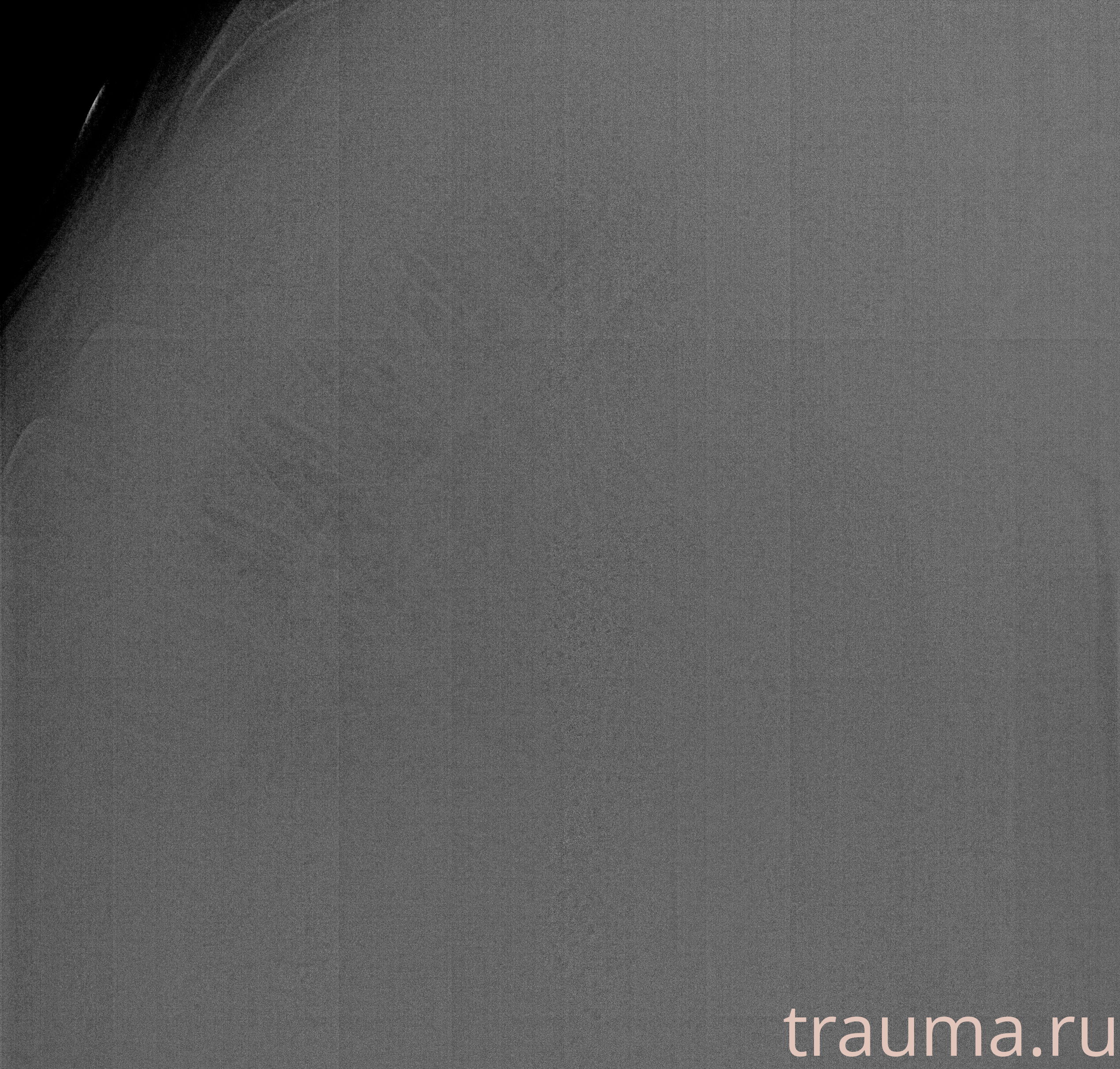 Рентген на дому: по вашему адресу приезжает врач-рентгенолог, травматолог-ортопед с мобильным рентгеновским аппаратом, проводит диагностику травмы или заболевания, делает необходимые рентгенограммы, дает рекомендации по дальнейшему лечению. Получить качественные снимки в домашних условиях возможно благодаря уникальной методике, разработанной МосРентген Центром для института  Склифосовского