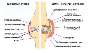 Методы хирургического лечения локальных дефектов гиалинового хряща крупных суставов (обзор литературы) Методы хирургического лечения локальных дефектов гиалинового хряща крупных суставов (обзор литературы)