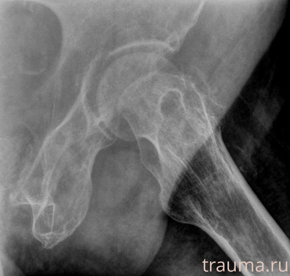 Рентген на дому: по вашему адресу приезжает врач-рентгенолог, травматолог-ортопед с мобильным рентгеновским аппаратом, проводит диагностику травмы или заболевания, делает необходимые рентгенограммы, дает рекомендации по дальнейшему лечению. Получить качественные снимки в домашних условиях возможно благодаря уникальной методике, разработанной МосРентген Центром для института  Склифосовского