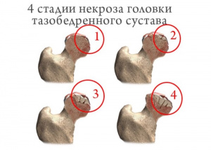 Консервативное лечение асептического некроза головки бедренной кости у взрослых (обзор литературы) Консервативное лечение асептического некроза головки бедренной кости у взрослых (обзор литературы)