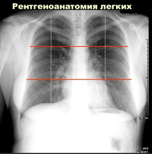 Рентгеноанатомические основы исследования легких . Введение Рентгеноанатомические основы исследования легких . Введение