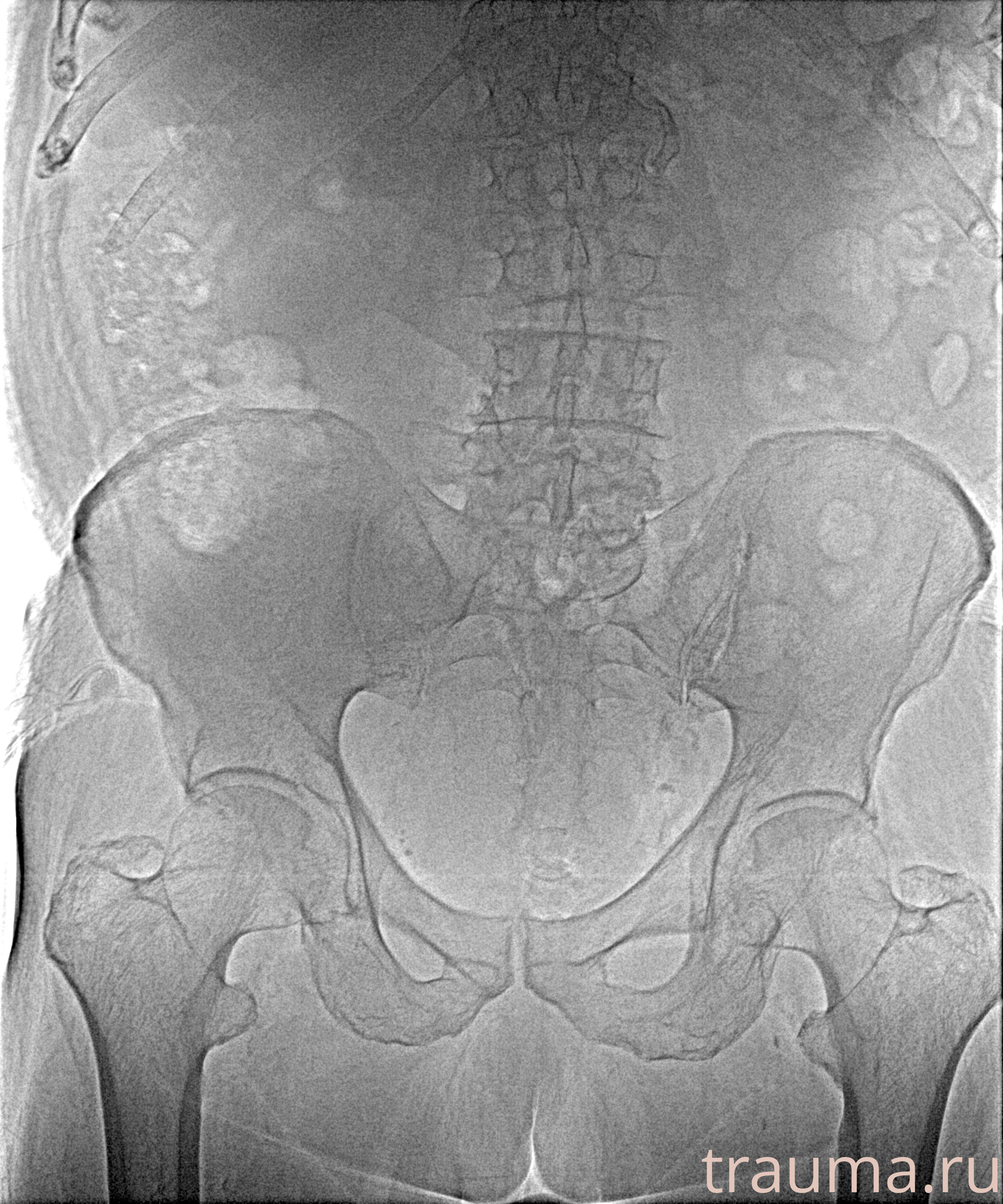 Рентген на дому: по вашему адресу приезжает врач-рентгенолог, травматолог-ортопед с мобильным рентгеновским аппаратом, проводит диагностику травмы или заболевания, делает необходимые рентгенограммы, дает рекомендации по дальнейшему лечению. Получить качественные снимки в домашних условиях возможно благодаря уникальной методике, разработанной МосРентген Центром для института  Склифосовского