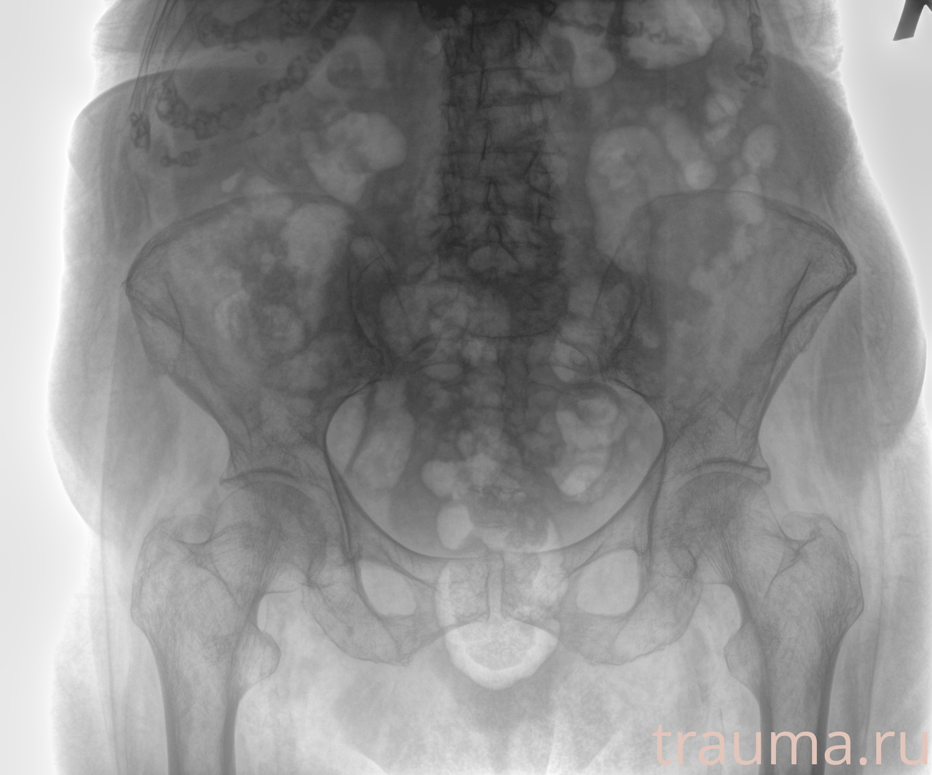 Рентген на дому: по вашему адресу приезжает врач-рентгенолог, травматолог-ортопед с мобильным рентгеновским аппаратом, проводит диагностику травмы или заболевания, делает необходимые рентгенограммы, дает рекомендации по дальнейшему лечению. Получить качественные снимки в домашних условиях возможно благодаря уникальной методике, разработанной МосРентген Центром для института  Склифосовского