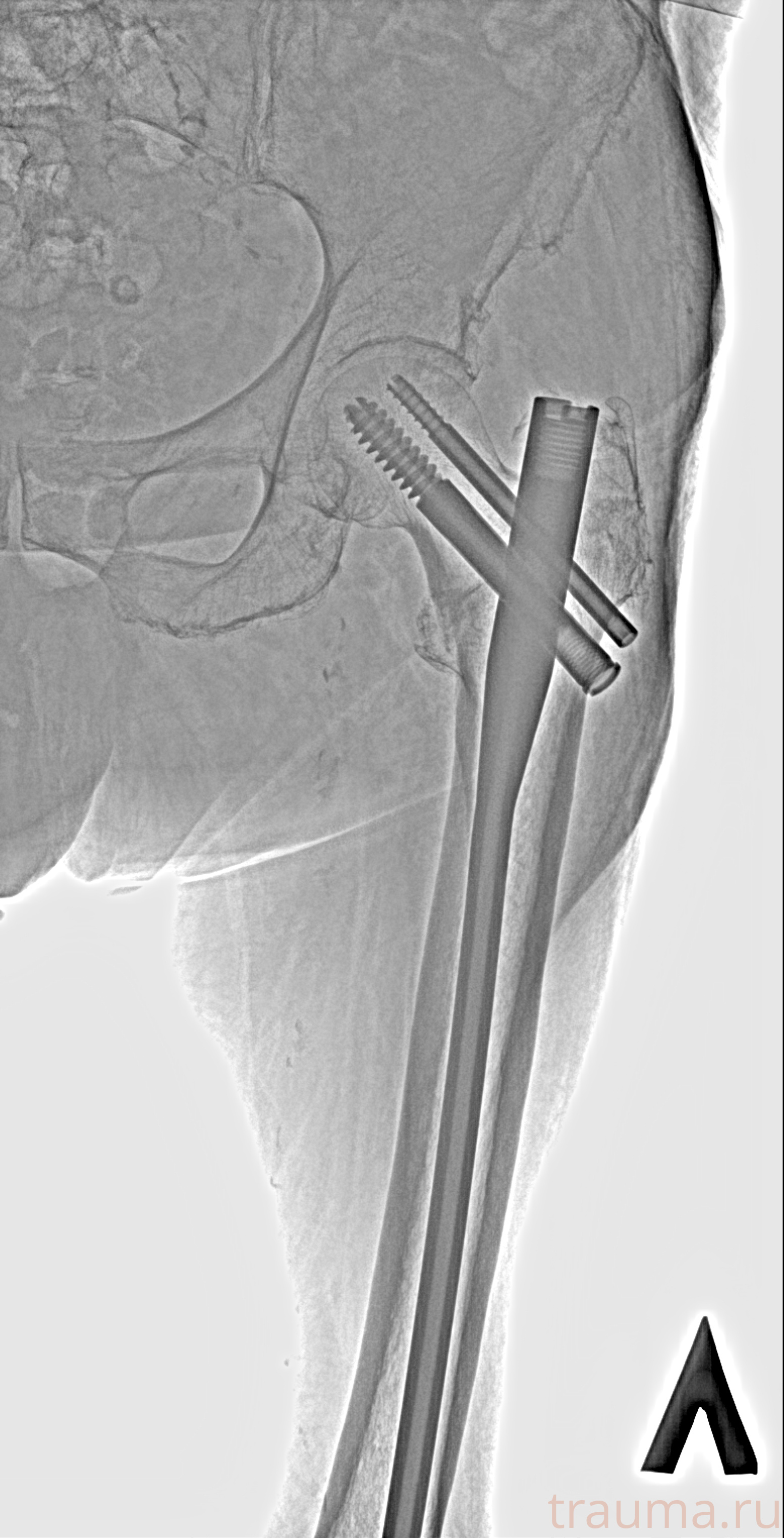 Рентген на дому: по вашему адресу приезжает врач-рентгенолог, травматолог-ортопед с мобильным рентгеновским аппаратом, проводит диагностику травмы или заболевания, делает необходимые рентгенограммы, дает рекомендации по дальнейшему лечению. Получить качественные снимки в домашних условиях возможно благодаря уникальной методике, разработанной МосРентген Центром для института  Склифосовского