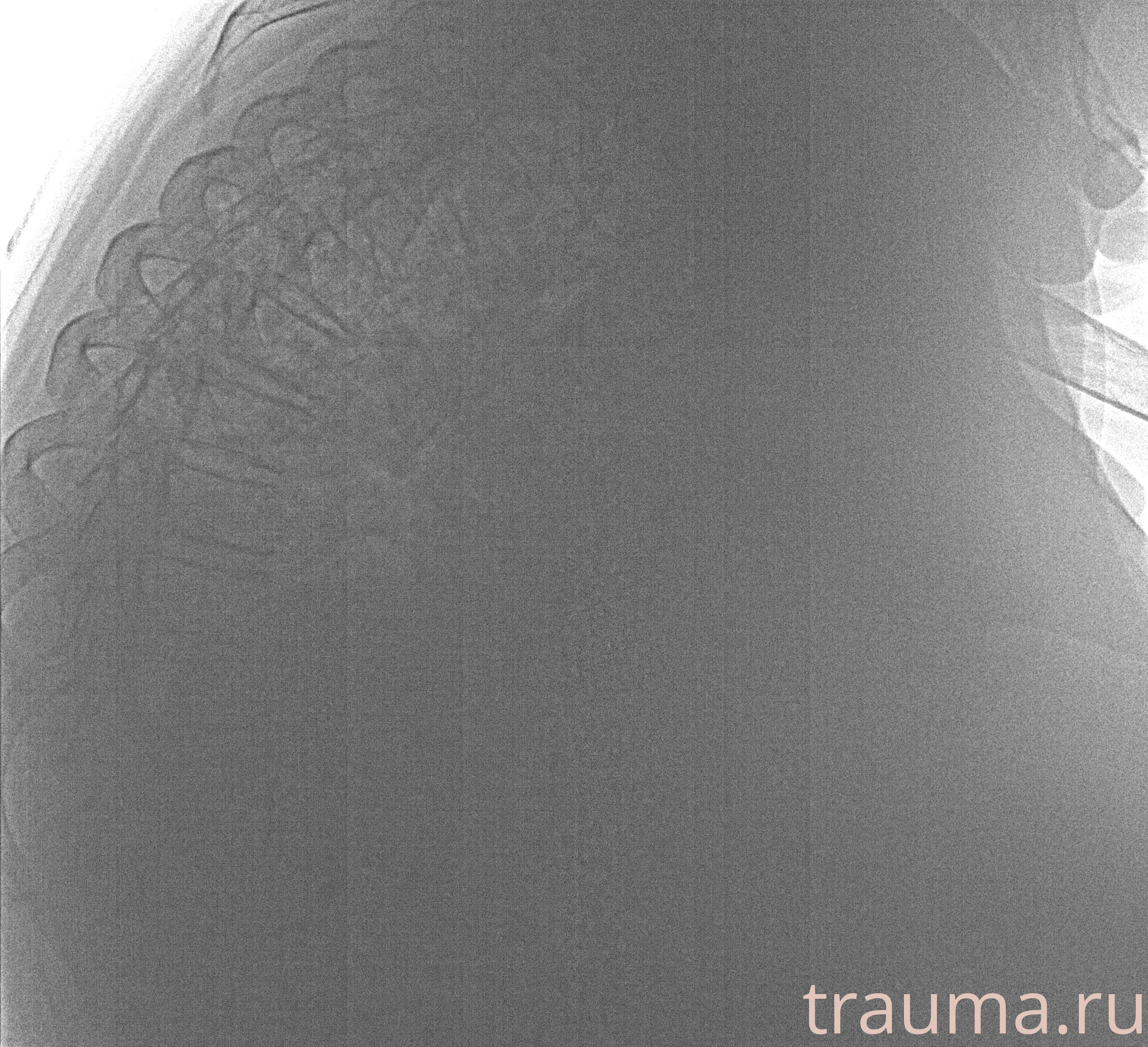 Рентген на дому: по вашему адресу приезжает врач-рентгенолог, травматолог-ортопед с мобильным рентгеновским аппаратом, проводит диагностику травмы или заболевания, делает необходимые рентгенограммы, дает рекомендации по дальнейшему лечению. Получить качественные снимки в домашних условиях возможно благодаря уникальной методике, разработанной МосРентген Центром для института  Склифосовского