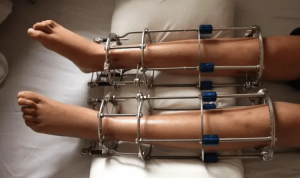 Автоматический круглосуточный контроль дистракционных усилий —
новая технология удлинения конечностей