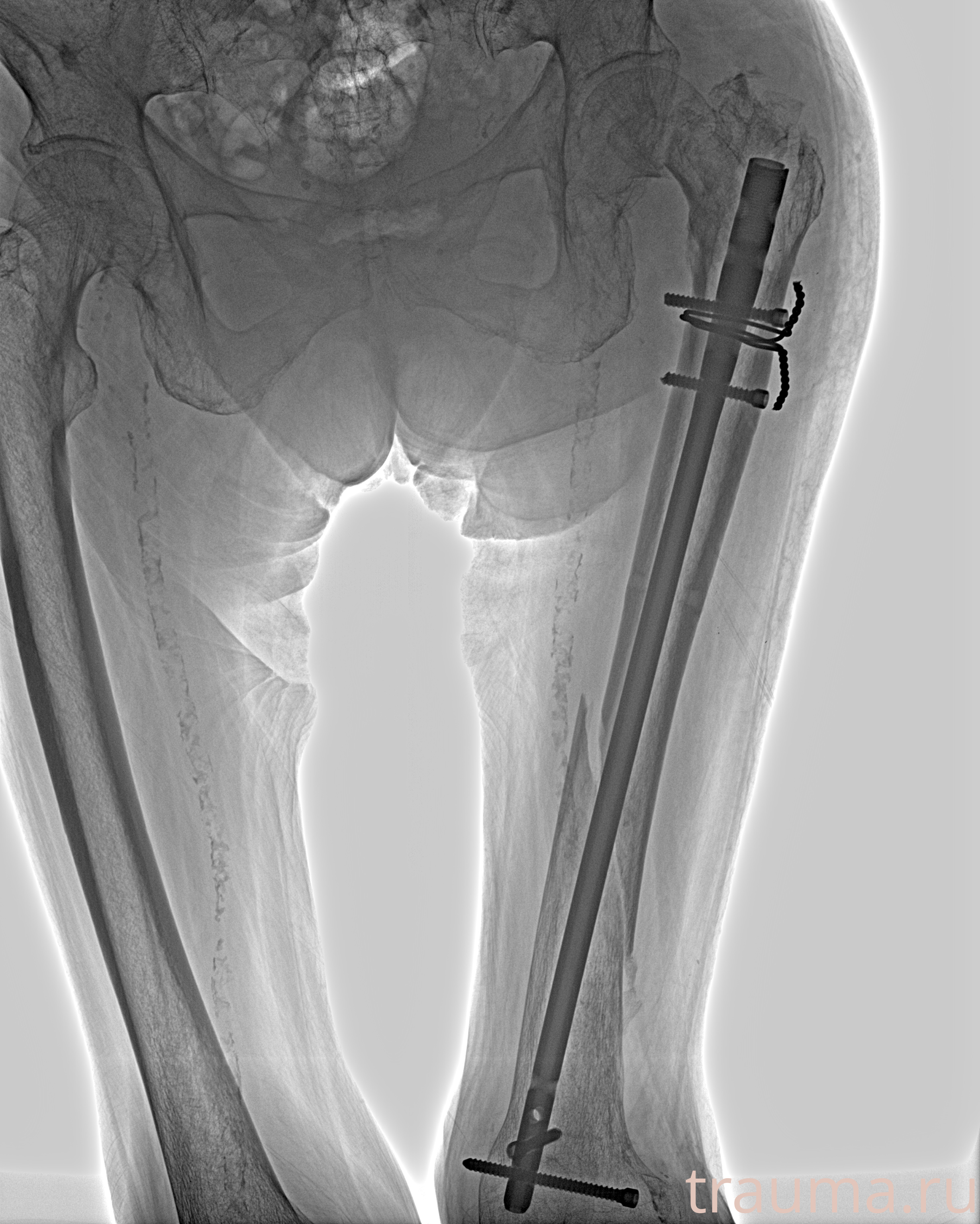 Рентген на дому: по вашему адресу приезжает врач-рентгенолог, травматолог-ортопед с мобильным рентгеновским аппаратом, проводит диагностику травмы или заболевания, делает необходимые рентгенограммы, дает рекомендации по дальнейшему лечению. Получить качественные снимки в домашних условиях возможно благодаря уникальной методике, разработанной МосРентген Центром для института  Склифосовского