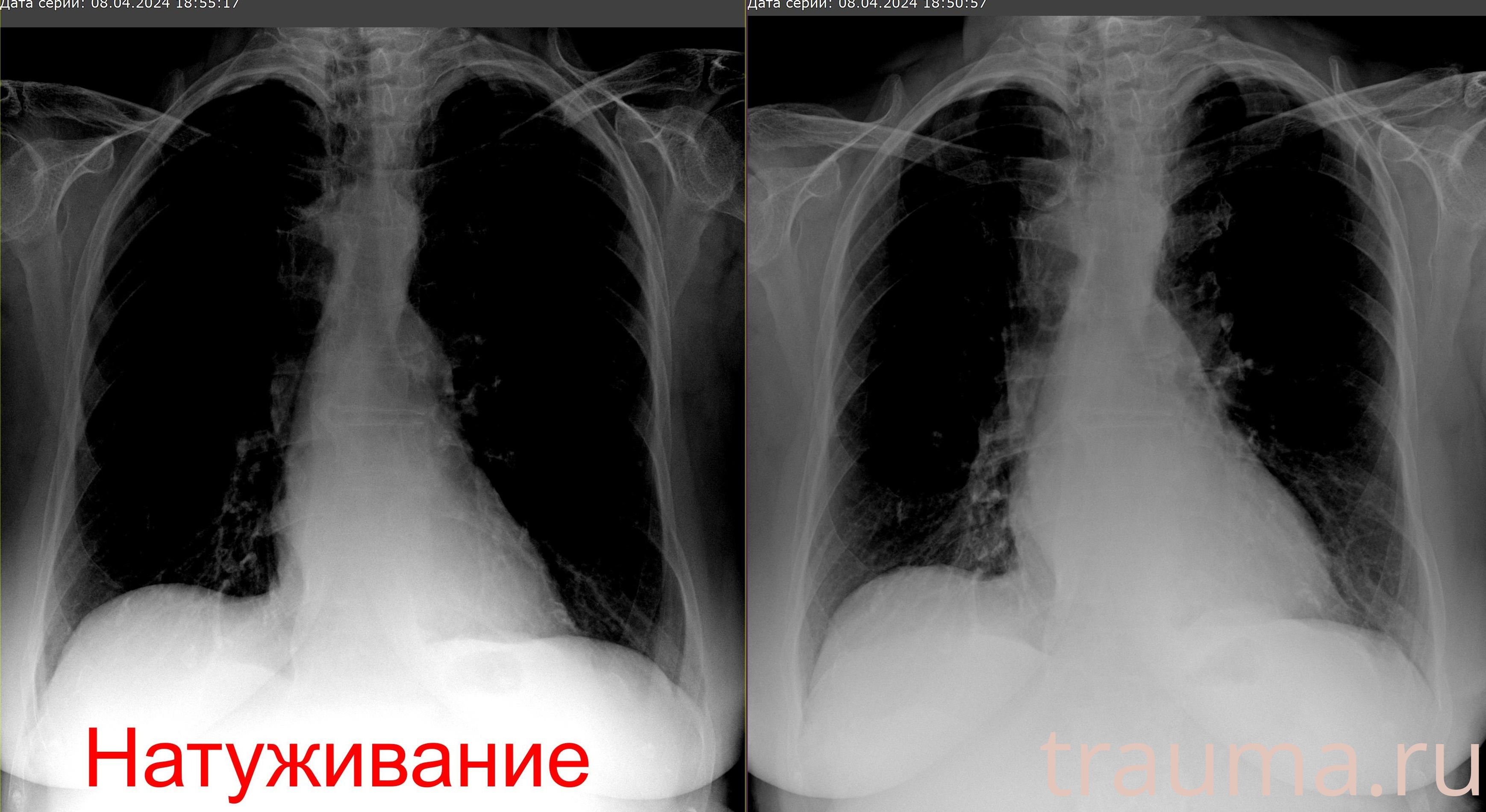 Рентген на дому: по вашему адресу приезжает врач-рентгенолог, травматолог-ортопед с мобильным рентгеновским аппаратом, проводит диагностику травмы или заболевания, делает необходимые рентгенограммы, дает рекомендации по дальнейшему лечению. Получить качественные снимки в домашних условиях возможно благодаря уникальной методике, разработанной МосРентген Центром для института  Склифосовского