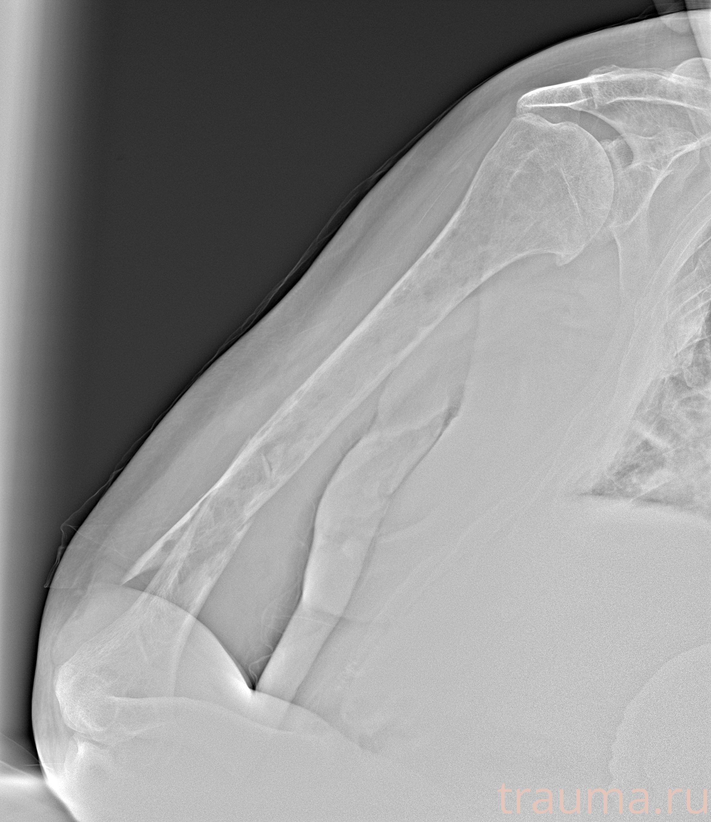 Рентген на дому: по вашему адресу приезжает врач-рентгенолог, травматолог-ортопед с мобильным рентгеновским аппаратом, проводит диагностику травмы или заболевания, делает необходимые рентгенограммы, дает рекомендации по дальнейшему лечению. Получить качественные снимки в домашних условиях возможно благодаря уникальной методике, разработанной МосРентген Центром для института  Склифосовского