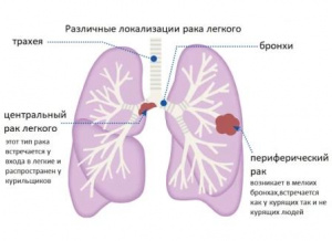 Дифференциальная рентгенодиагностика заболеваний органов дыхания и средостения(Часть 1)
Дифференциальная рентгенодиагностика заболеваний органов дыхания и средостения(Часть 1)