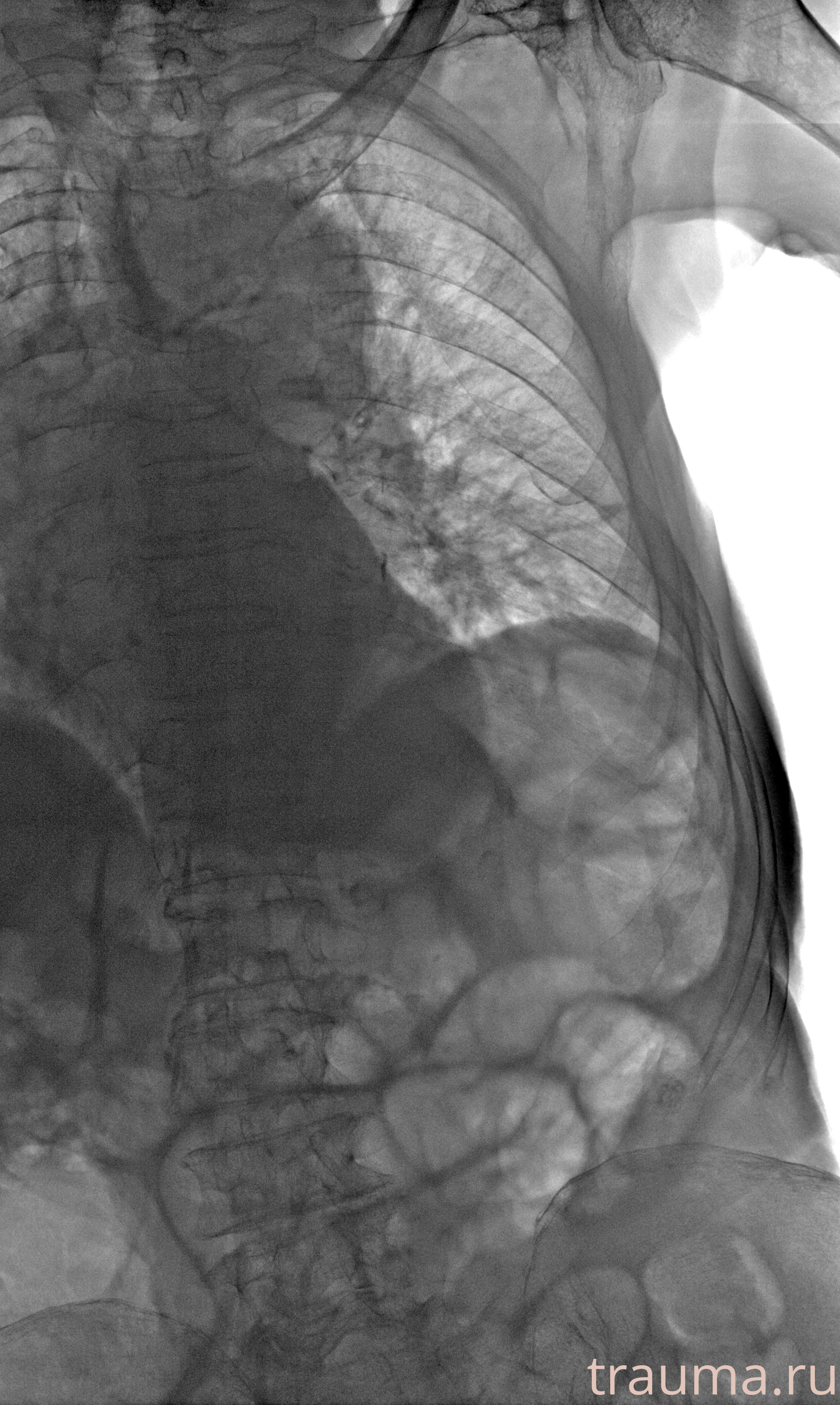 Рентген на дому: по вашему адресу приезжает врач-рентгенолог, травматолог-ортопед с мобильным рентгеновским аппаратом, проводит диагностику травмы или заболевания, делает необходимые рентгенограммы, дает рекомендации по дальнейшему лечению. Получить качественные снимки в домашних условиях возможно благодаря уникальной методике, разработанной МосРентген Центром для института  Склифосовского