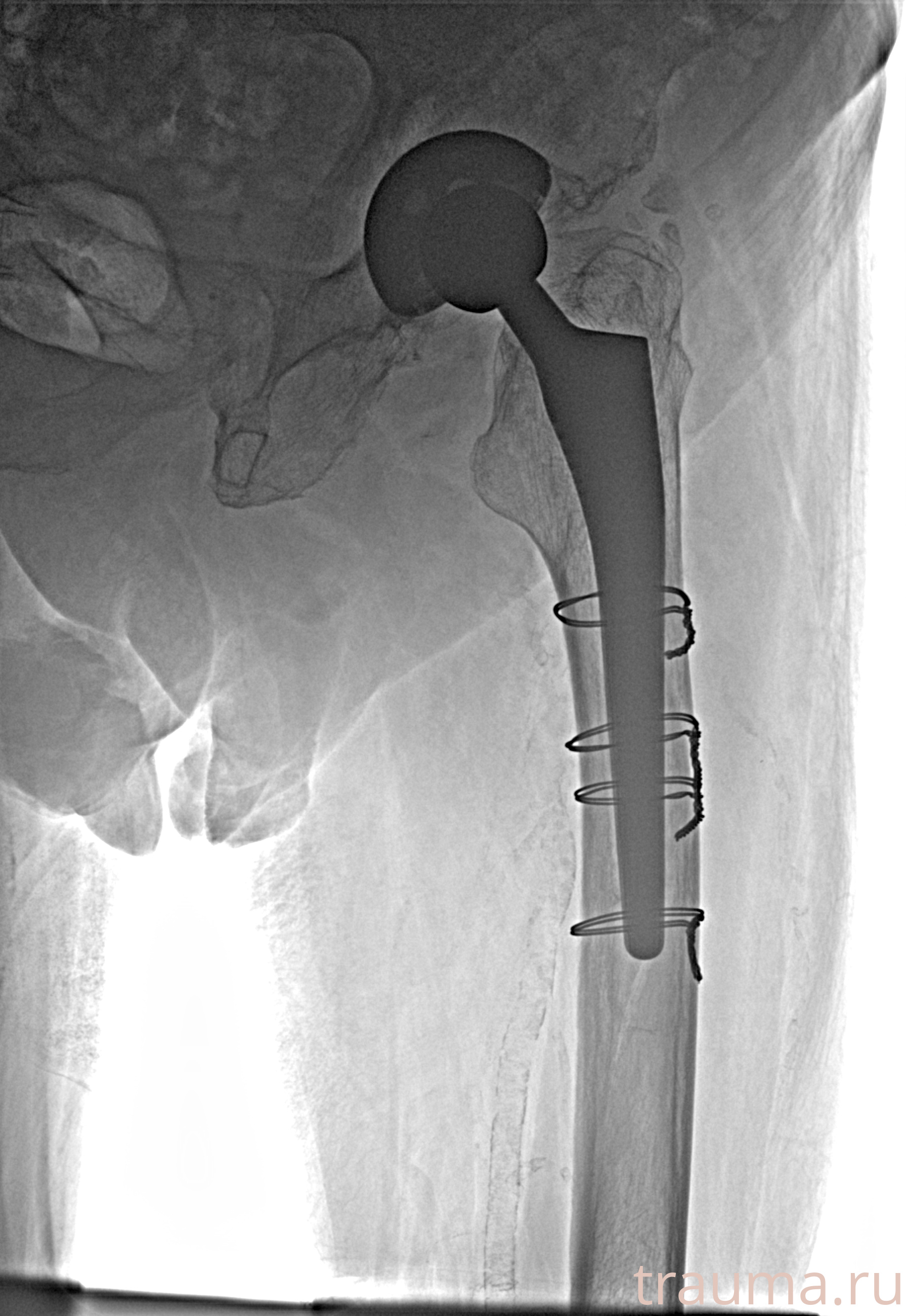 Рентген на дому: по вашему адресу приезжает врач-рентгенолог, травматолог-ортопед с мобильным рентгеновским аппаратом, проводит диагностику травмы или заболевания, делает необходимые рентгенограммы, дает рекомендации по дальнейшему лечению. Получить качественные снимки в домашних условиях возможно благодаря уникальной методике, разработанной МосРентген Центром для института  Склифосовского