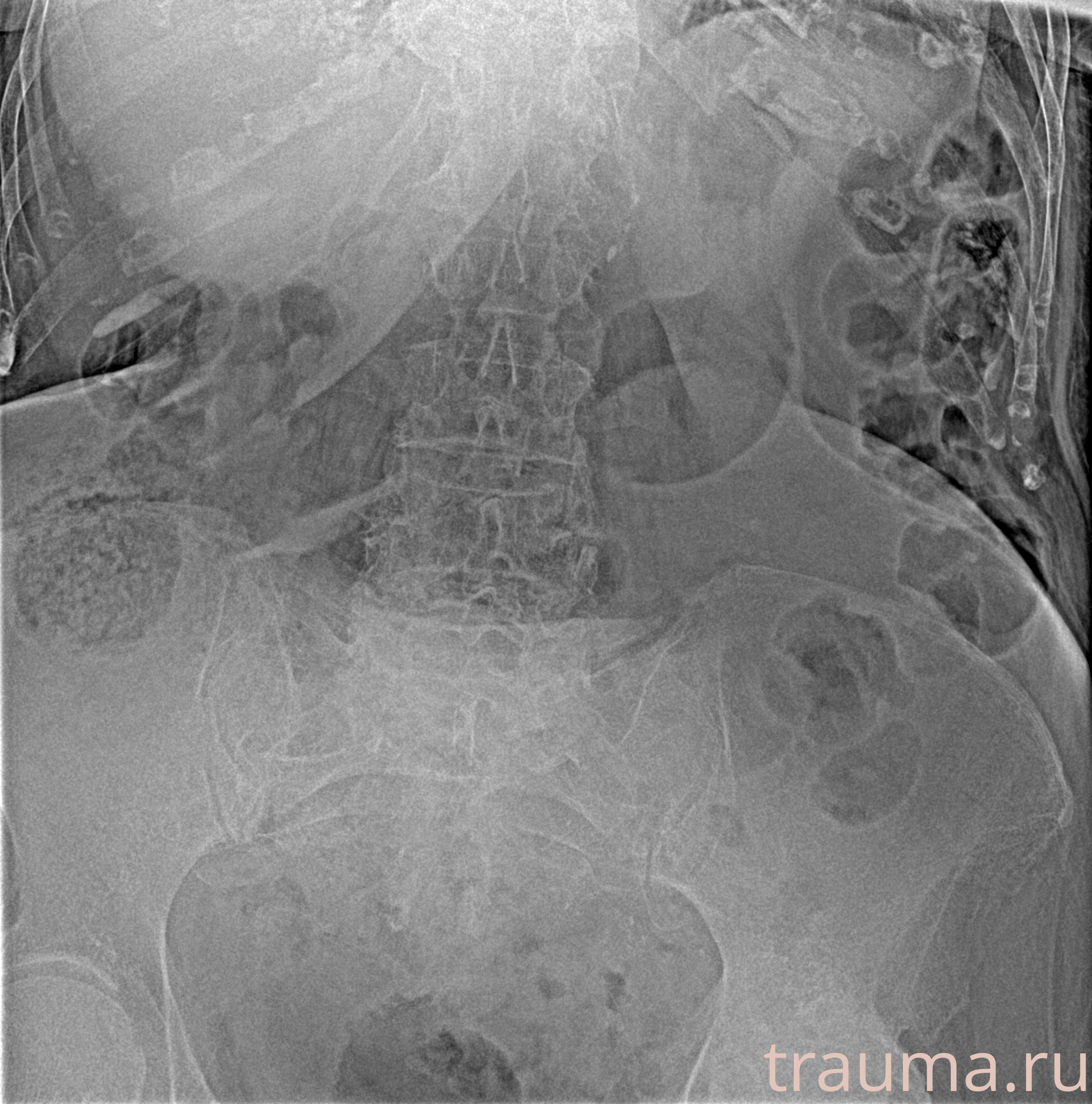 Рентген на дому: по вашему адресу приезжает врач-рентгенолог, травматолог-ортопед с мобильным рентгеновским аппаратом, проводит диагностику травмы или заболевания, делает необходимые рентгенограммы, дает рекомендации по дальнейшему лечению. Получить качественные снимки в домашних условиях возможно благодаря уникальной методике, разработанной МосРентген Центром для института  Склифосовского