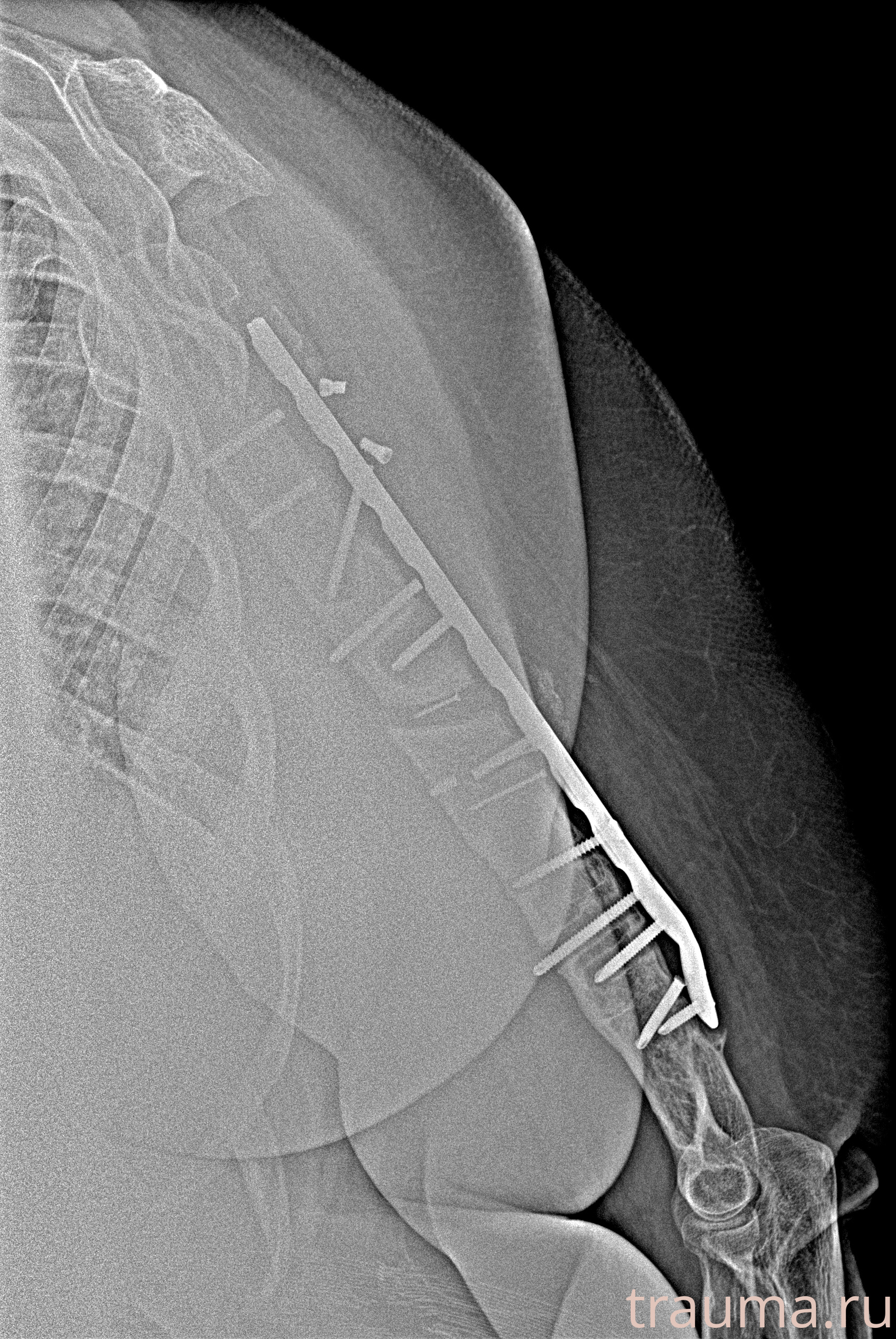Рентген на дому: по вашему адресу приезжает врач-рентгенолог, травматолог-ортопед с мобильным рентгеновским аппаратом, проводит диагностику травмы или заболевания, делает необходимые рентгенограммы, дает рекомендации по дальнейшему лечению. Получить качественные снимки в домашних условиях возможно благодаря уникальной методике, разработанной МосРентген Центром для института  Склифосовского