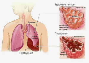 Показатели системного воспаления у больных внегоспитальной пневмонией на фоне хронической патологии гепатобилярной системы
Показатели системного воспаления у больных внегоспитальной пневмонией на фоне хронической патологии гепатобилярной системы