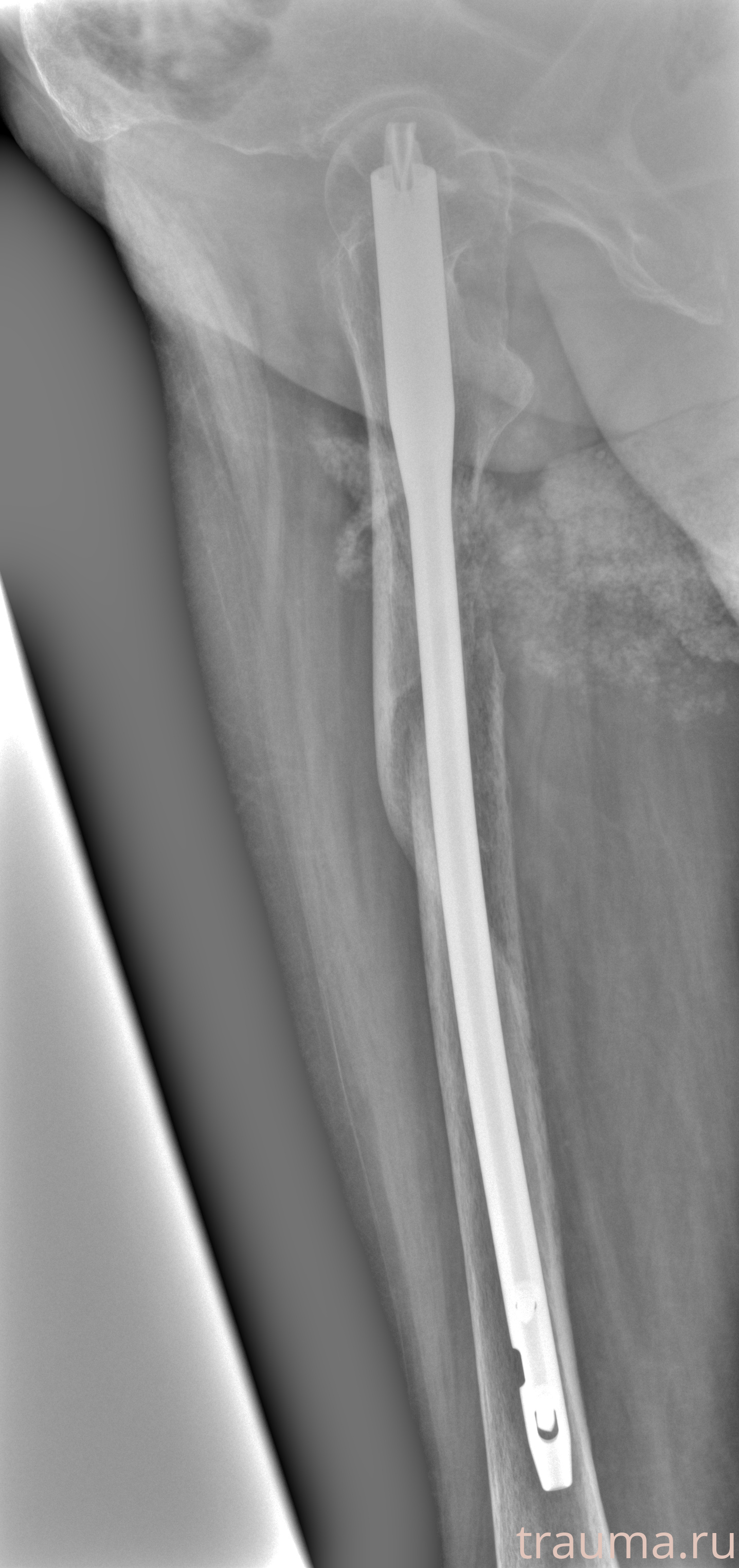 Рентген на дому: по вашему адресу приезжает врач-рентгенолог, травматолог-ортопед с мобильным рентгеновским аппаратом, проводит диагностику травмы или заболевания, делает необходимые рентгенограммы, дает рекомендации по дальнейшему лечению. Получить качественные снимки в домашних условиях возможно благодаря уникальной методике, разработанной МосРентген Центром для института  Склифосовского