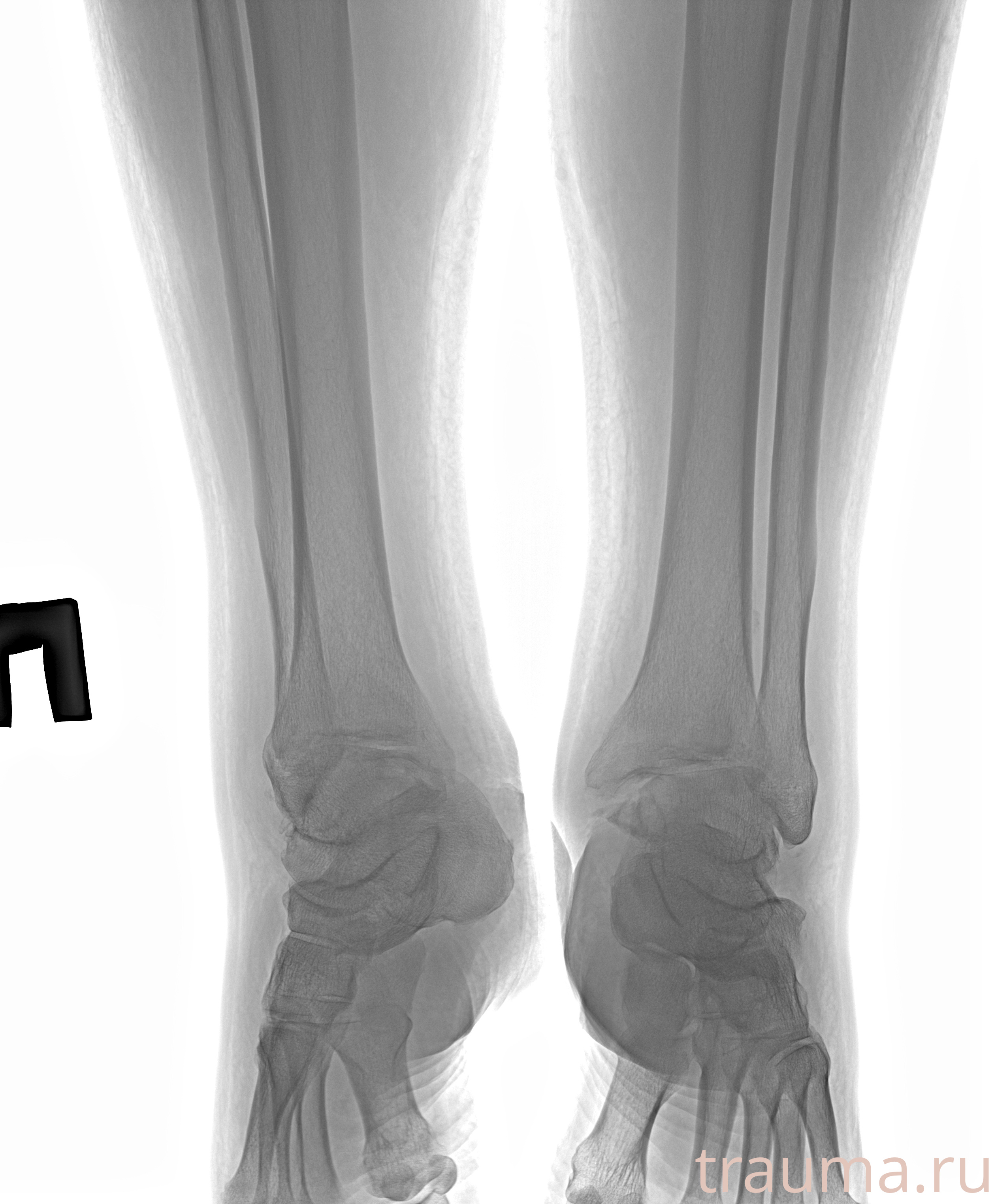 Рентген на дому: по вашему адресу приезжает врач-рентгенолог, травматолог-ортопед с мобильным рентгеновским аппаратом, проводит диагностику травмы или заболевания, делает необходимые рентгенограммы, дает рекомендации по дальнейшему лечению. Получить качественные снимки в домашних условиях возможно благодаря уникальной методике, разработанной МосРентген Центром для института  Склифосовского