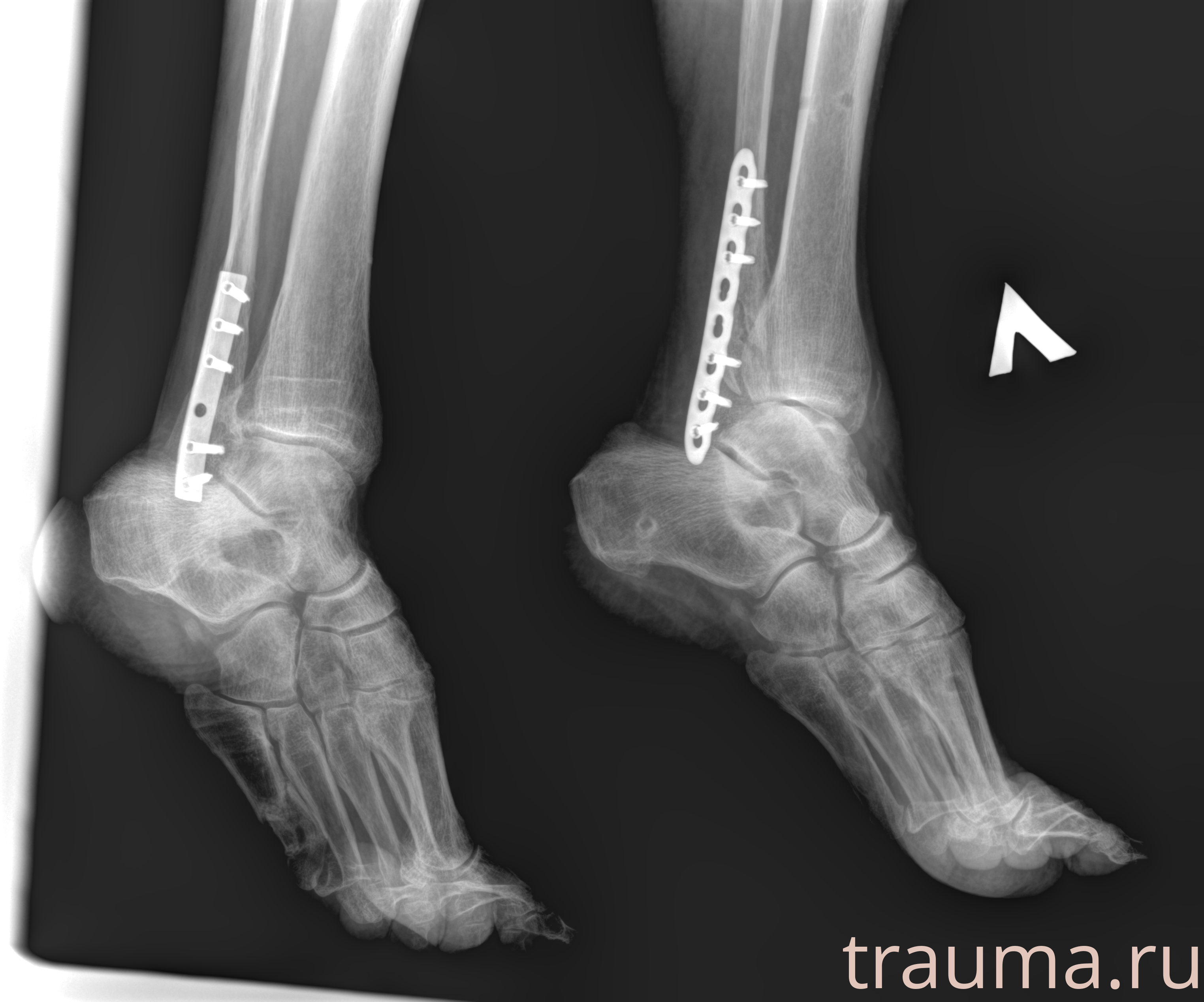 Рентген на дому: по вашему адресу приезжает врач-рентгенолог, травматолог-ортопед с мобильным рентгеновским аппаратом, проводит диагностику травмы или заболевания, делает необходимые рентгенограммы, дает рекомендации по дальнейшему лечению. Получить качественные снимки в домашних условиях возможно благодаря уникальной методике, разработанной МосРентген Центром для института  Склифосовского