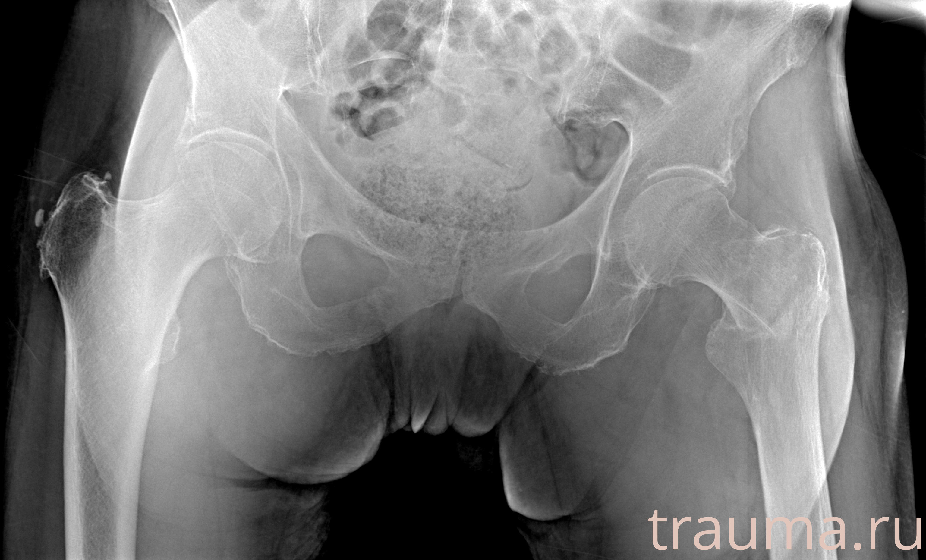 Рентген на дому: по вашему адресу приезжает врач-рентгенолог, травматолог-ортопед с мобильным рентгеновским аппаратом, проводит диагностику травмы или заболевания, делает необходимые рентгенограммы, дает рекомендации по дальнейшему лечению. Получить качественные снимки в домашних условиях возможно благодаря уникальной методике, разработанной МосРентген Центром для института  Склифосовского