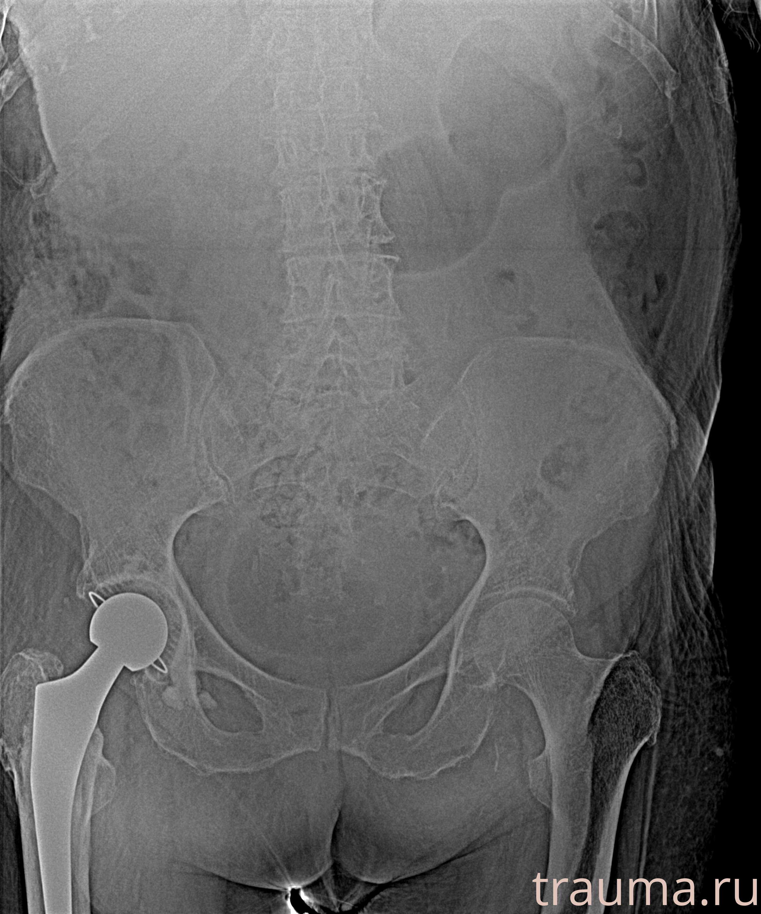 Рентген на дому: по вашему адресу приезжает врач-рентгенолог, травматолог-ортопед с мобильным рентгеновским аппаратом, проводит диагностику травмы или заболевания, делает необходимые рентгенограммы, дает рекомендации по дальнейшему лечению. Получить качественные снимки в домашних условиях возможно благодаря уникальной методике, разработанной МосРентген Центром для института  Склифосовского