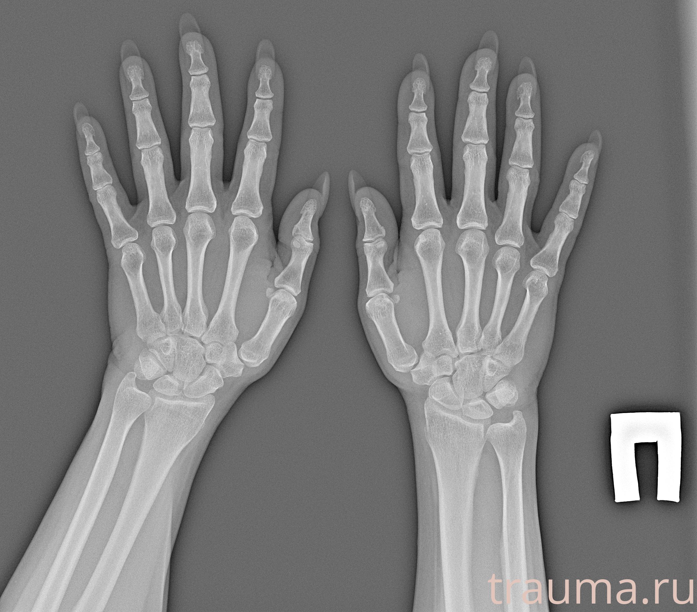 Рентген на дому: по вашему адресу приезжает врач-рентгенолог, травматолог-ортопед с мобильным рентгеновским аппаратом, проводит диагностику травмы или заболевания, делает необходимые рентгенограммы, дает рекомендации по дальнейшему лечению. Получить качественные снимки в домашних условиях возможно благодаря уникальной методике, разработанной МосРентген Центром для института  Склифосовского