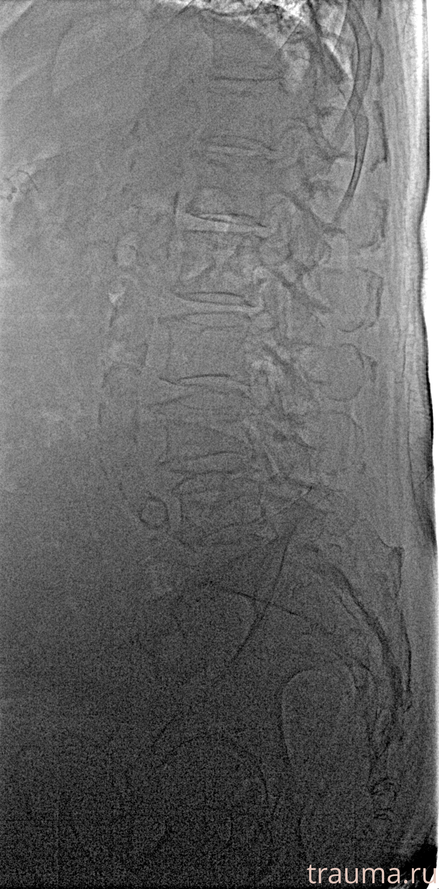 Рентген на дому: по вашему адресу приезжает врач-рентгенолог, травматолог-ортопед с мобильным рентгеновским аппаратом, проводит диагностику травмы или заболевания, делает необходимые рентгенограммы, дает рекомендации по дальнейшему лечению. Получить качественные снимки в домашних условиях возможно благодаря уникальной методике, разработанной МосРентген Центром для института  Склифосовского