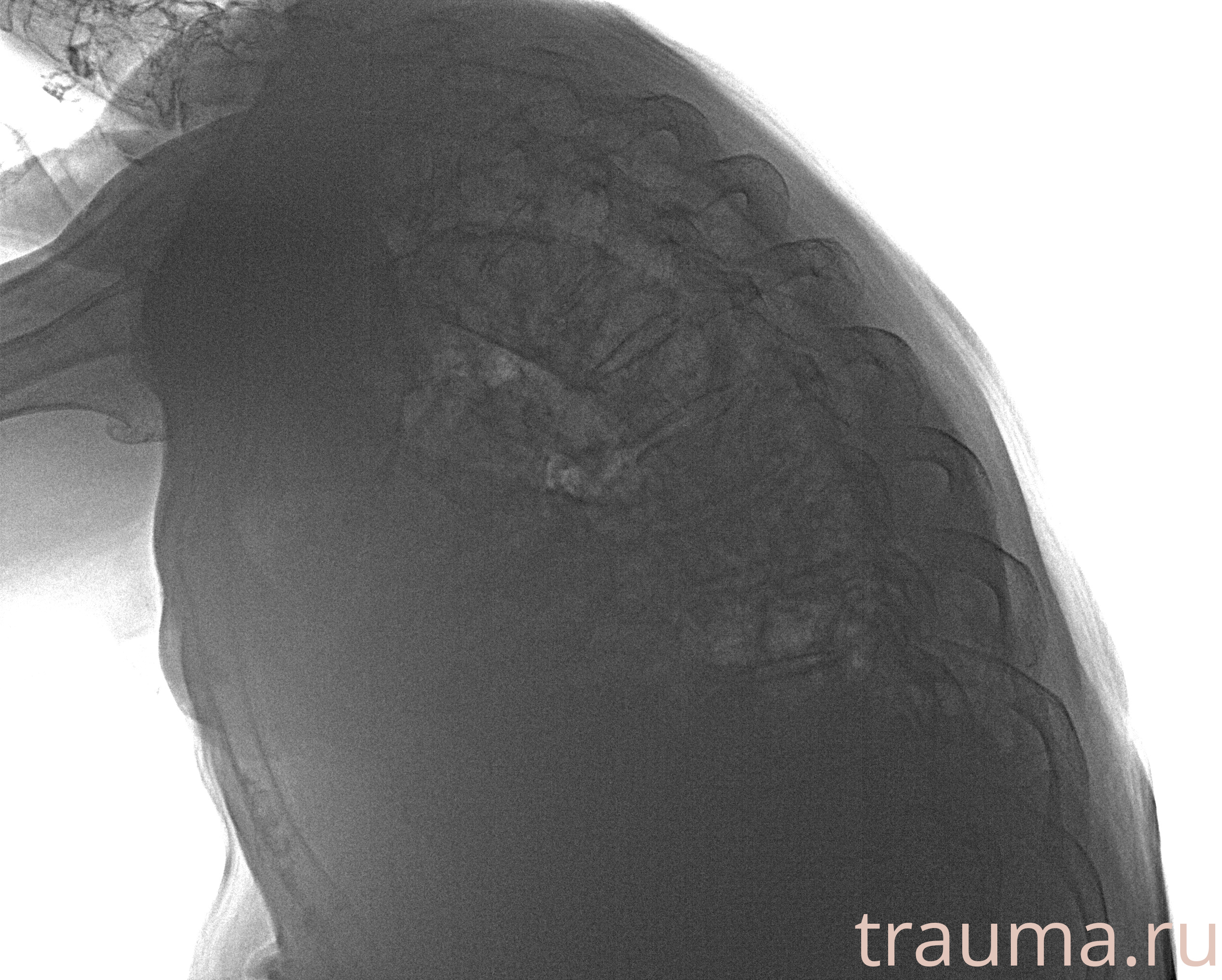 Рентген на дому: по вашему адресу приезжает врач-рентгенолог, травматолог-ортопед с мобильным рентгеновским аппаратом, проводит диагностику травмы или заболевания, делает необходимые рентгенограммы, дает рекомендации по дальнейшему лечению. Получить качественные снимки в домашних условиях возможно благодаря уникальной методике, разработанной МосРентген Центром для института  Склифосовского
