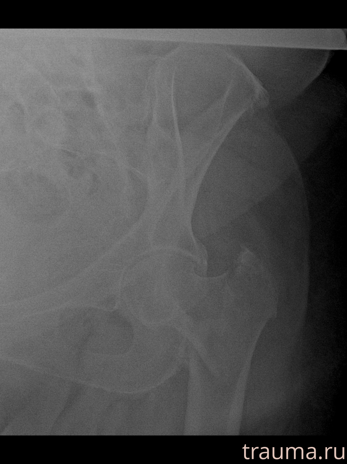 Рентген на дому: по вашему адресу приезжает врач-рентгенолог, травматолог-ортопед с мобильным рентгеновским аппаратом, проводит диагностику травмы или заболевания, делает необходимые рентгенограммы, дает рекомендации по дальнейшему лечению. Получить качественные снимки в домашних условиях возможно благодаря уникальной методике, разработанной МосРентген Центром для института  Склифосовского