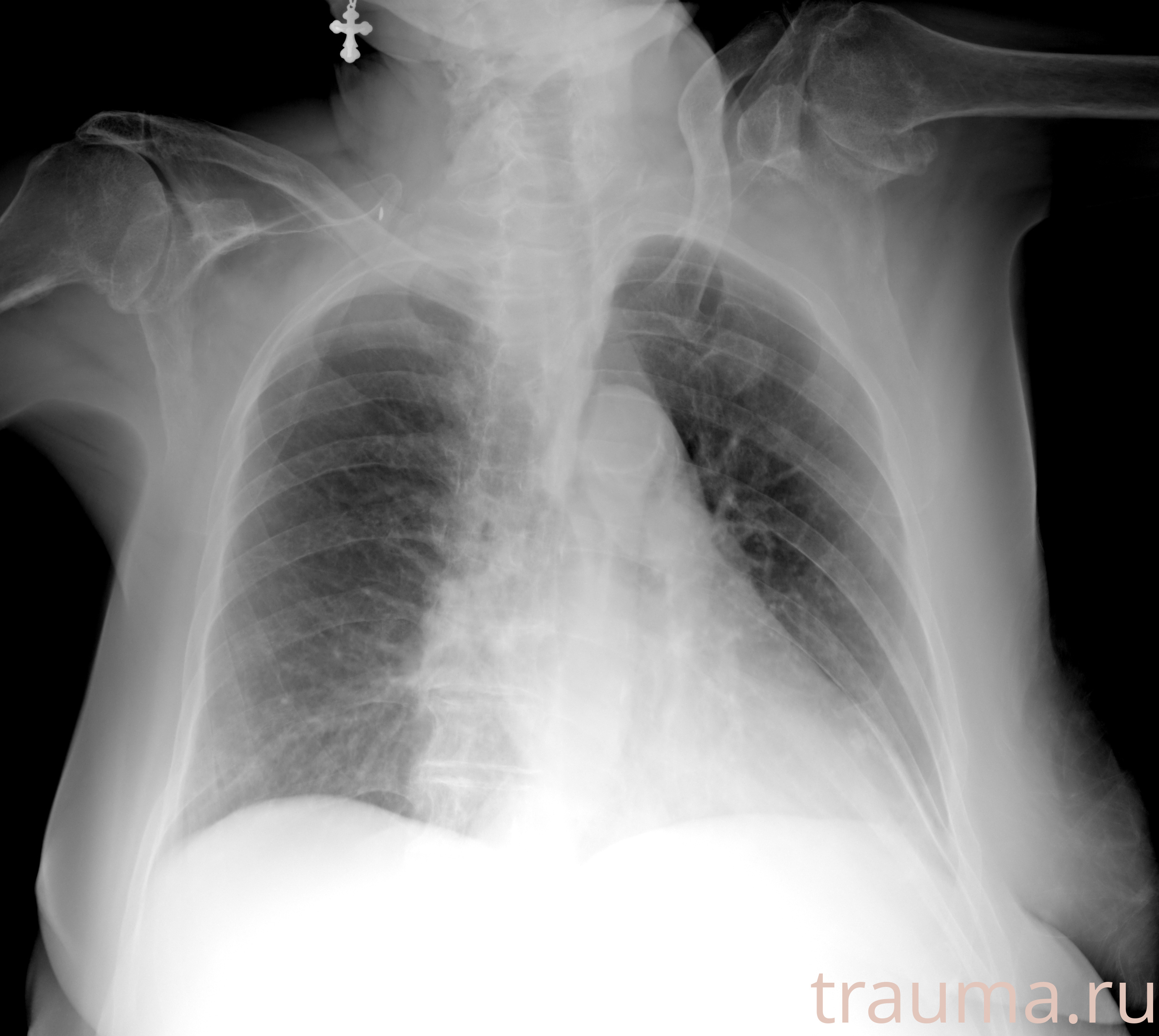 Рентген на дому: по вашему адресу приезжает врач-рентгенолог, травматолог-ортопед с мобильным рентгеновским аппаратом, проводит диагностику травмы или заболевания, делает необходимые рентгенограммы, дает рекомендации по дальнейшему лечению. Получить качественные снимки в домашних условиях возможно благодаря уникальной методике, разработанной МосРентген Центром для института  Склифосовского