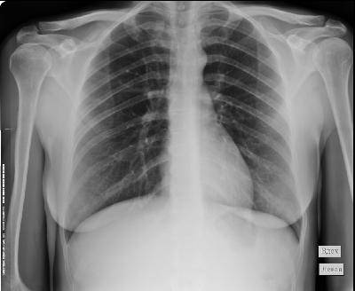 Почему рентген грудной клетки делают стоя?