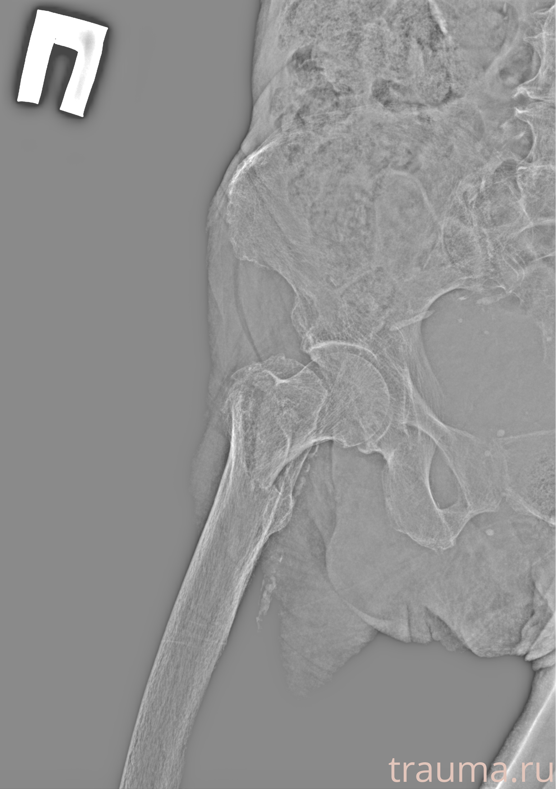 Рентген на дому: по вашему адресу приезжает врач-рентгенолог, травматолог-ортопед с мобильным рентгеновским аппаратом, проводит диагностику травмы или заболевания, делает необходимые рентгенограммы, дает рекомендации по дальнейшему лечению. Получить качественные снимки в домашних условиях возможно благодаря уникальной методике, разработанной МосРентген Центром для института  Склифосовского