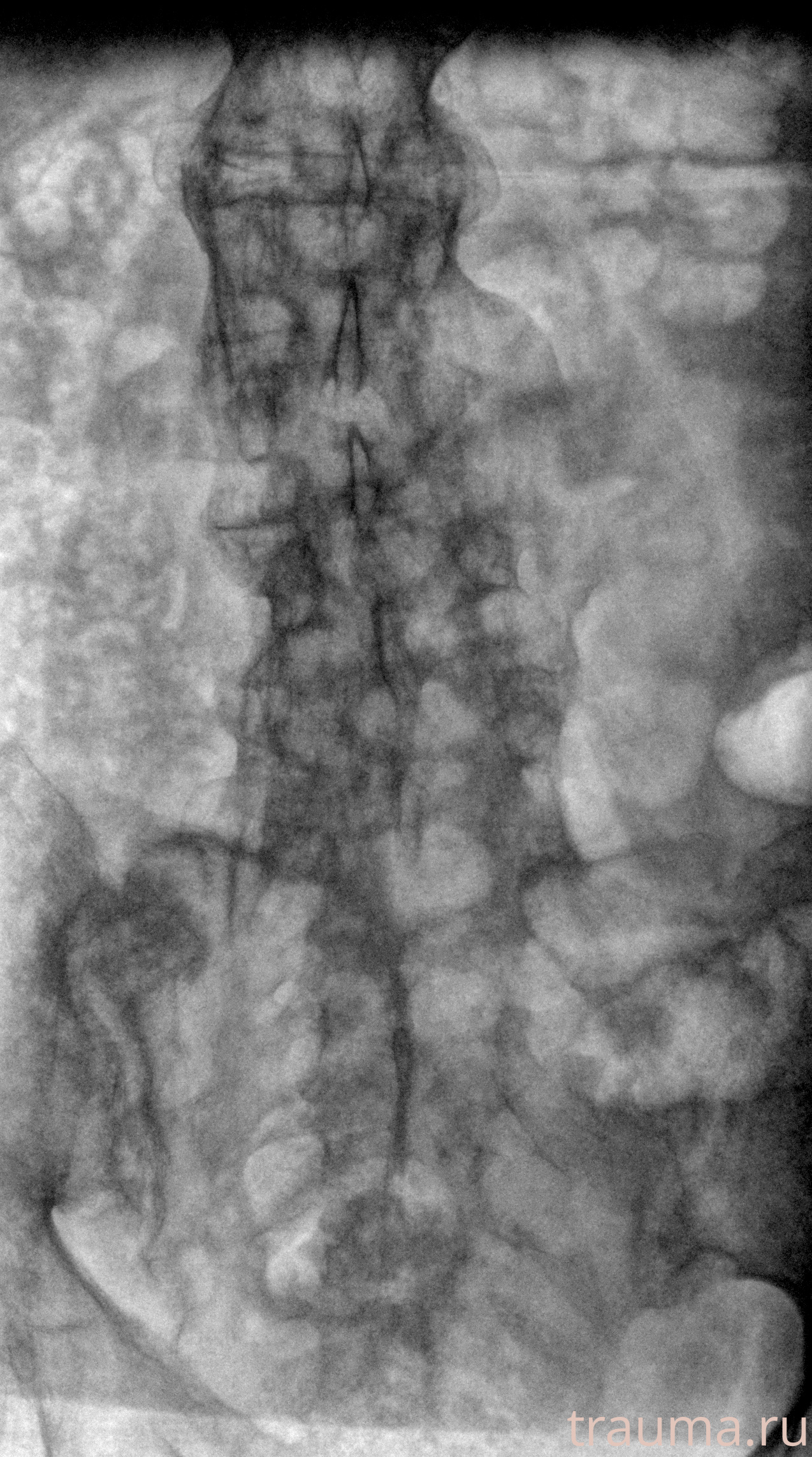 Рентген на дому: по вашему адресу приезжает врач-рентгенолог, травматолог-ортопед с мобильным рентгеновским аппаратом, проводит диагностику травмы или заболевания, делает необходимые рентгенограммы, дает рекомендации по дальнейшему лечению. Получить качественные снимки в домашних условиях возможно благодаря уникальной методике, разработанной МосРентген Центром для института  Склифосовского