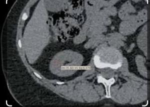Методика оценки раздельной функции почек при компьютерной томографии:ретроспективное  исследование