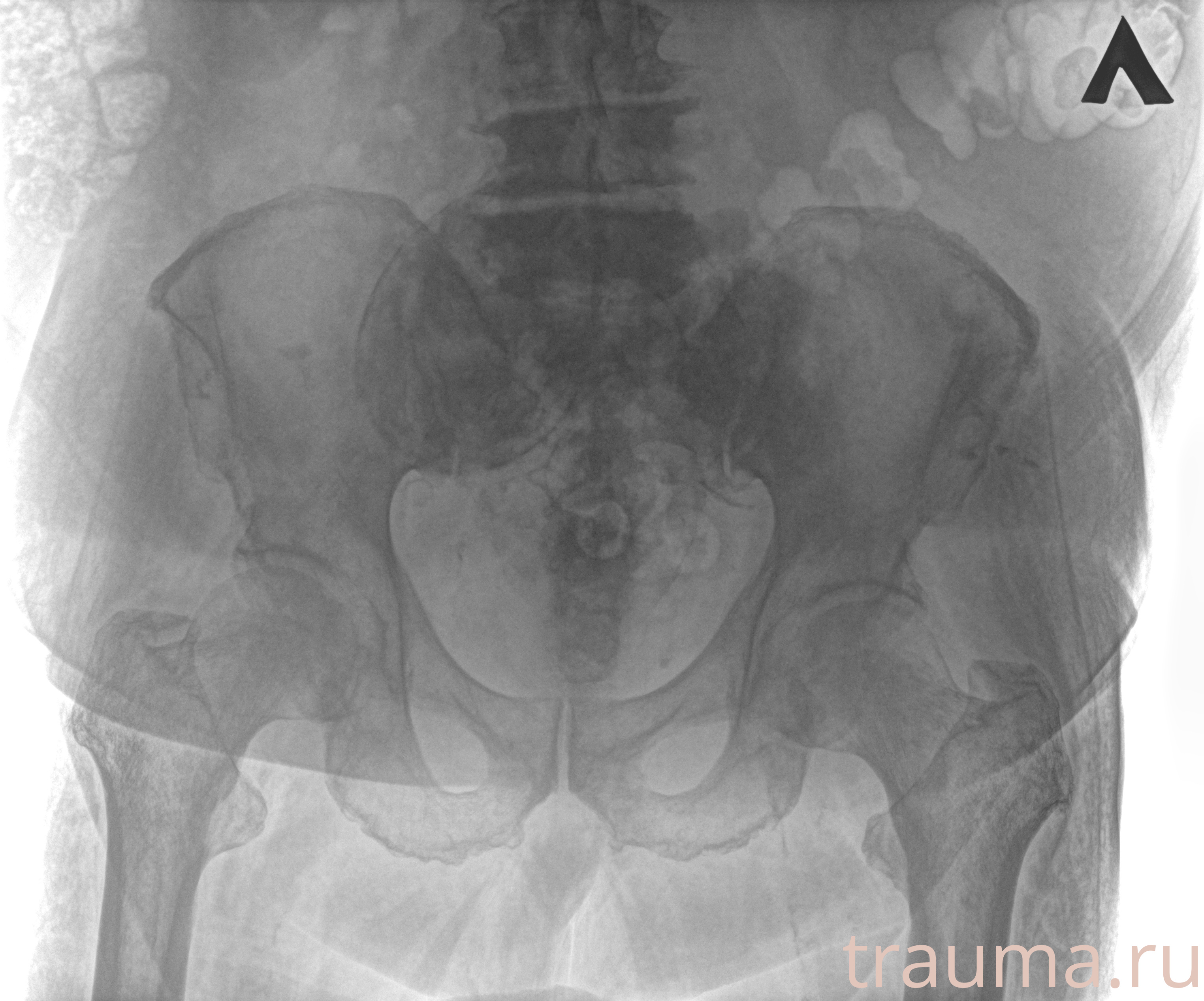 Рентген на дому: по вашему адресу приезжает врач-рентгенолог, травматолог-ортопед с мобильным рентгеновским аппаратом, проводит диагностику травмы или заболевания, делает необходимые рентгенограммы, дает рекомендации по дальнейшему лечению. Получить качественные снимки в домашних условиях возможно благодаря уникальной методике, разработанной МосРентген Центром для института  Склифосовского