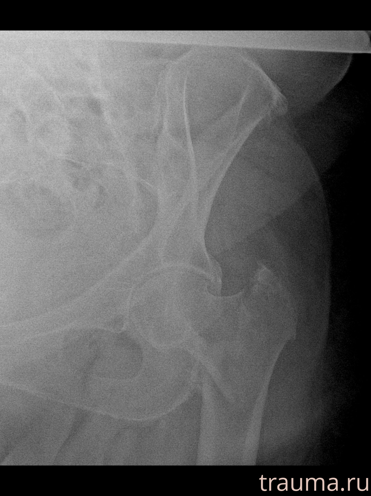 Рентген на дому: по вашему адресу приезжает врач-рентгенолог, травматолог-ортопед с мобильным рентгеновским аппаратом, проводит диагностику травмы или заболевания, делает необходимые рентгенограммы, дает рекомендации по дальнейшему лечению. Получить качественные снимки в домашних условиях возможно благодаря уникальной методике, разработанной МосРентген Центром для института  Склифосовского