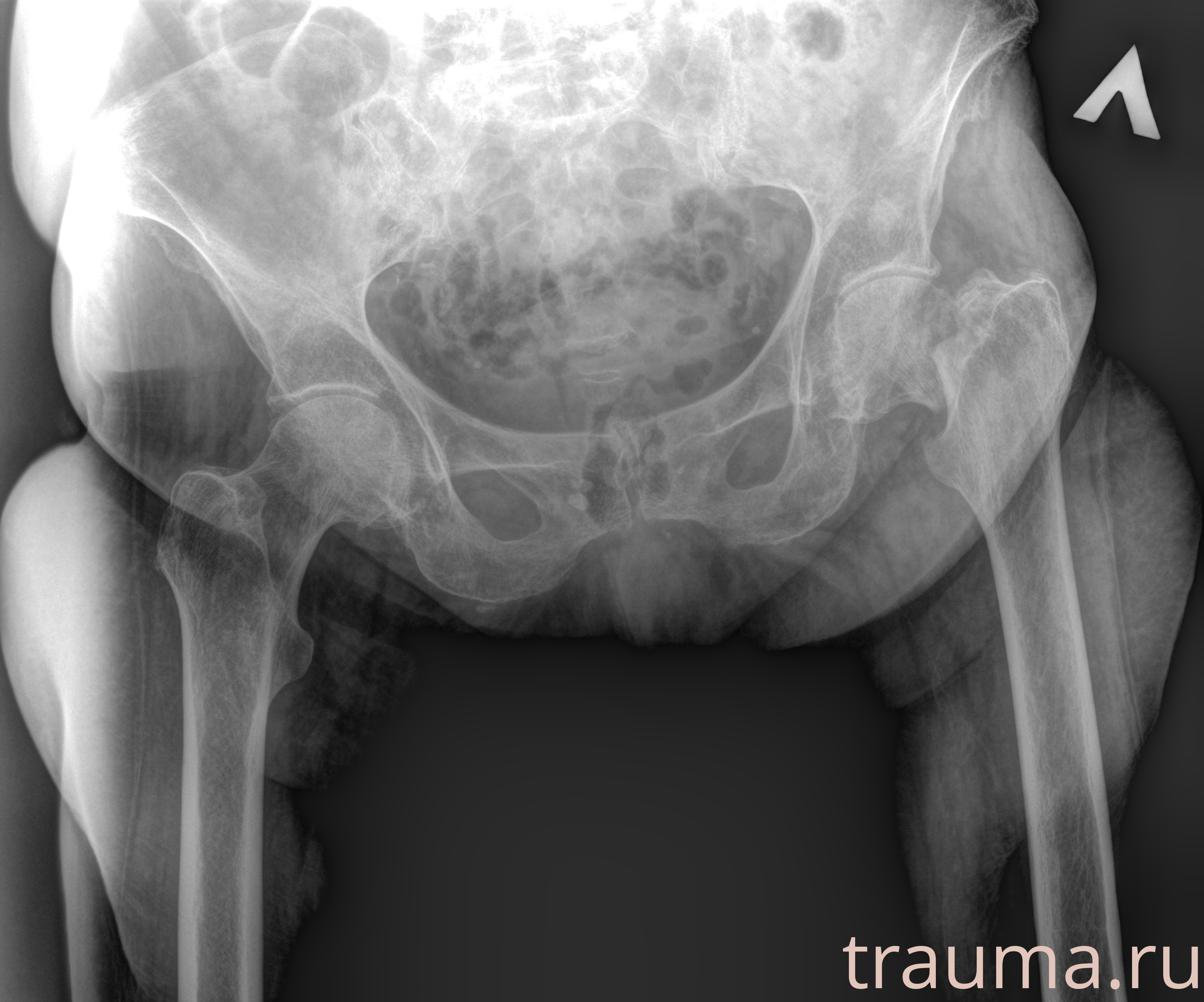 Рентген на дому: по вашему адресу приезжает врач-рентгенолог, травматолог-ортопед с мобильным рентгеновским аппаратом, проводит диагностику травмы или заболевания, делает необходимые рентгенограммы, дает рекомендации по дальнейшему лечению. Получить качественные снимки в домашних условиях возможно благодаря уникальной методике, разработанной МосРентген Центром для института  Склифосовского