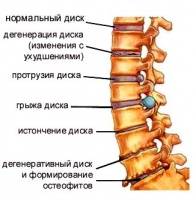 Деформация межпозвонкового диска и МРТ Деформация межпозвонкового диска и МРТ