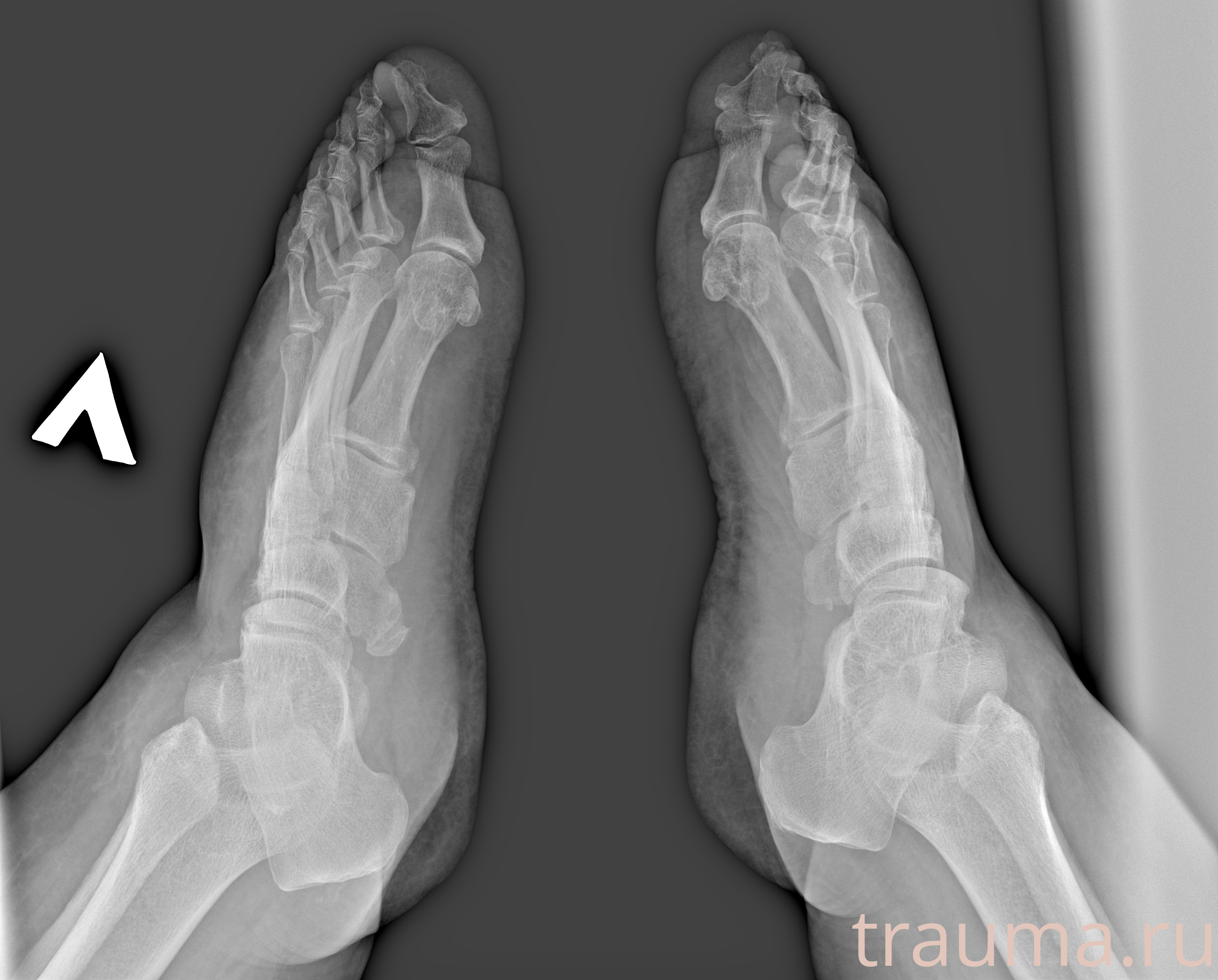 Рентген на дому: по вашему адресу приезжает врач-рентгенолог, травматолог-ортопед с мобильным рентгеновским аппаратом, проводит диагностику травмы или заболевания, делает необходимые рентгенограммы, дает рекомендации по дальнейшему лечению. Получить качественные снимки в домашних условиях возможно благодаря уникальной методике, разработанной МосРентген Центром для института  Склифосовского