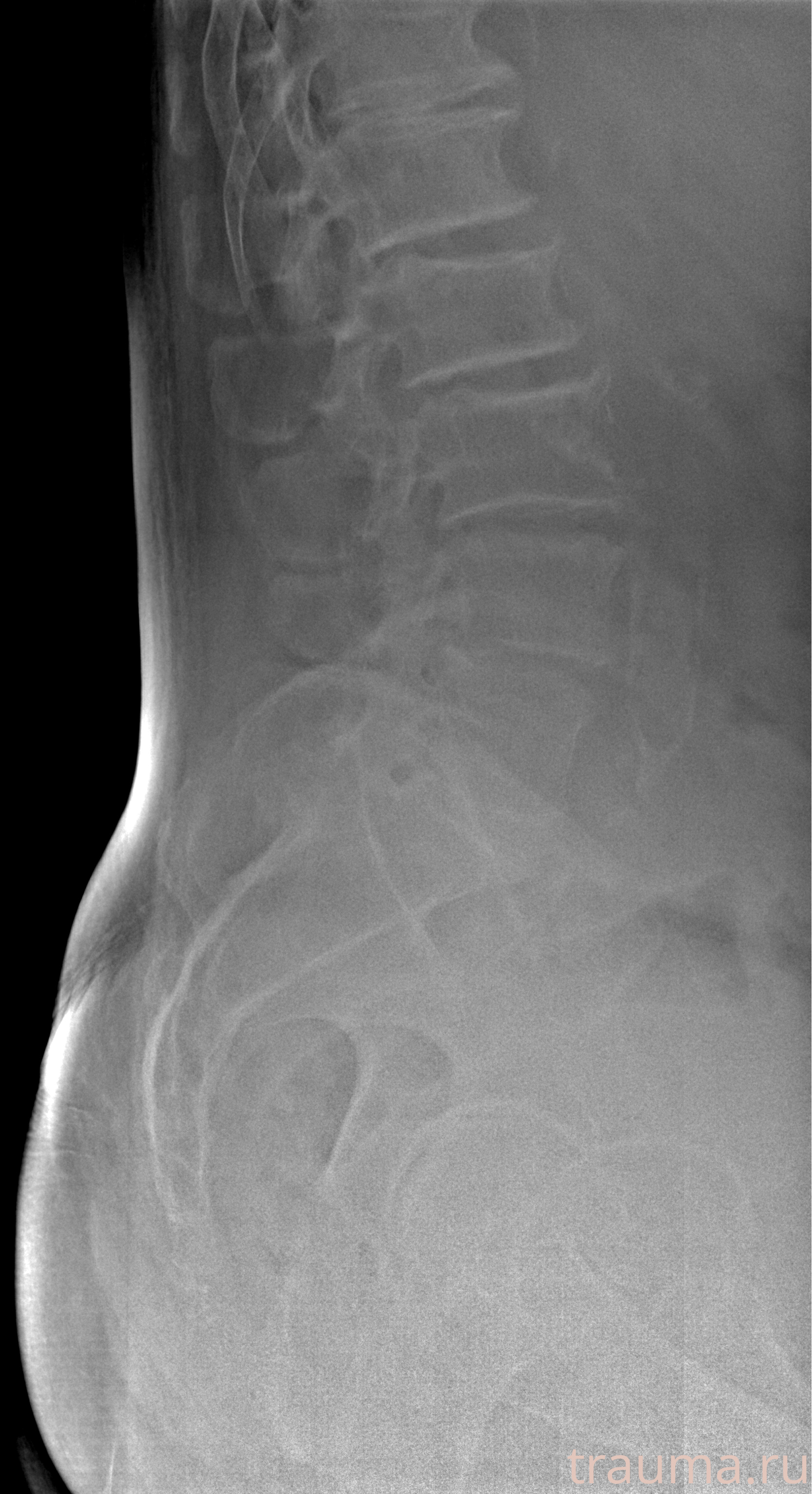 Рентген на дому: по вашему адресу приезжает врач-рентгенолог, травматолог-ортопед с мобильным рентгеновским аппаратом, проводит диагностику травмы или заболевания, делает необходимые рентгенограммы, дает рекомендации по дальнейшему лечению. Получить качественные снимки в домашних условиях возможно благодаря уникальной методике, разработанной МосРентген Центром для института  Склифосовского