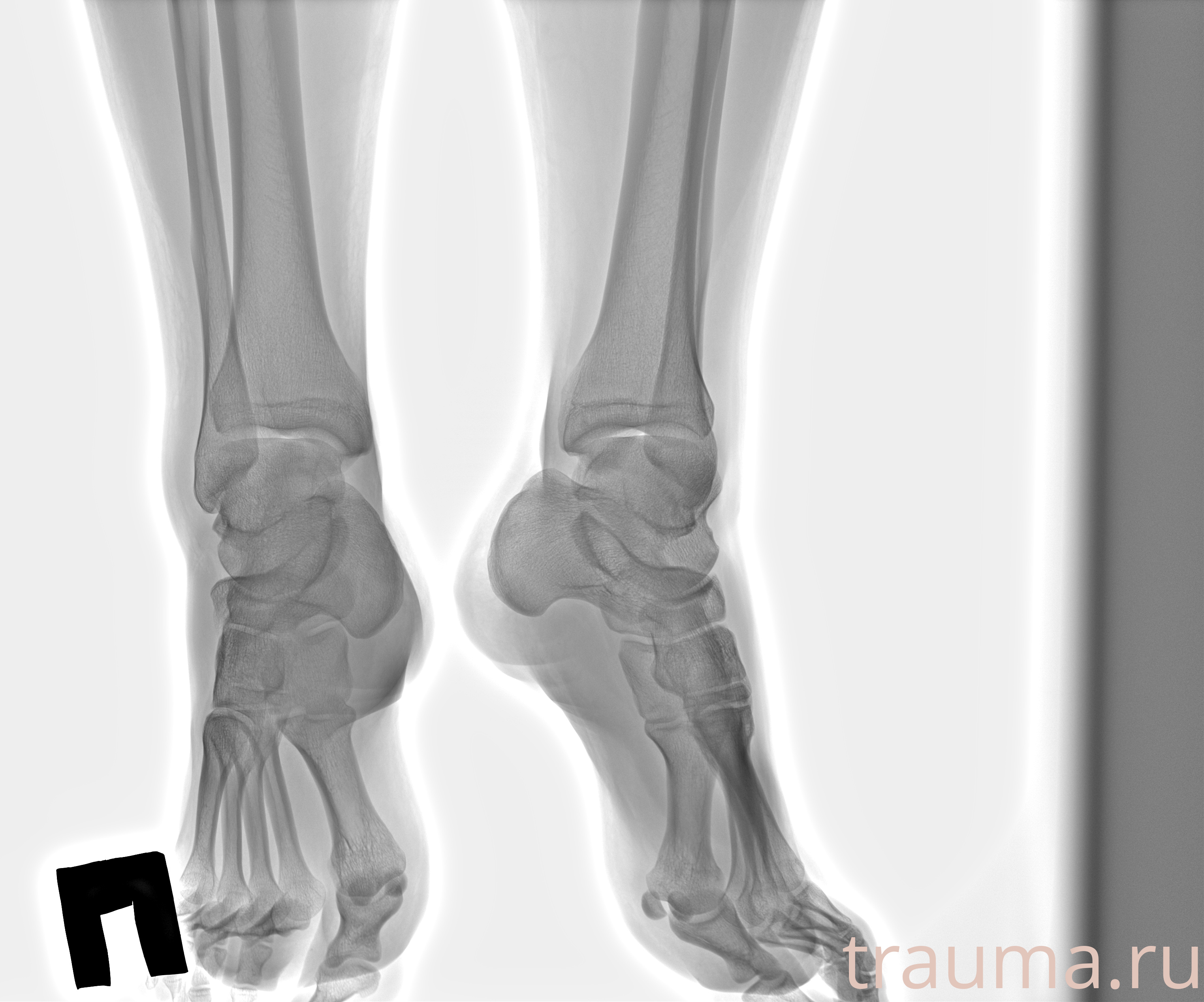 Рентген на дому: по вашему адресу приезжает врач-рентгенолог, травматолог-ортопед с мобильным рентгеновским аппаратом, проводит диагностику травмы или заболевания, делает необходимые рентгенограммы, дает рекомендации по дальнейшему лечению. Получить качественные снимки в домашних условиях возможно благодаря уникальной методике, разработанной МосРентген Центром для института  Склифосовского