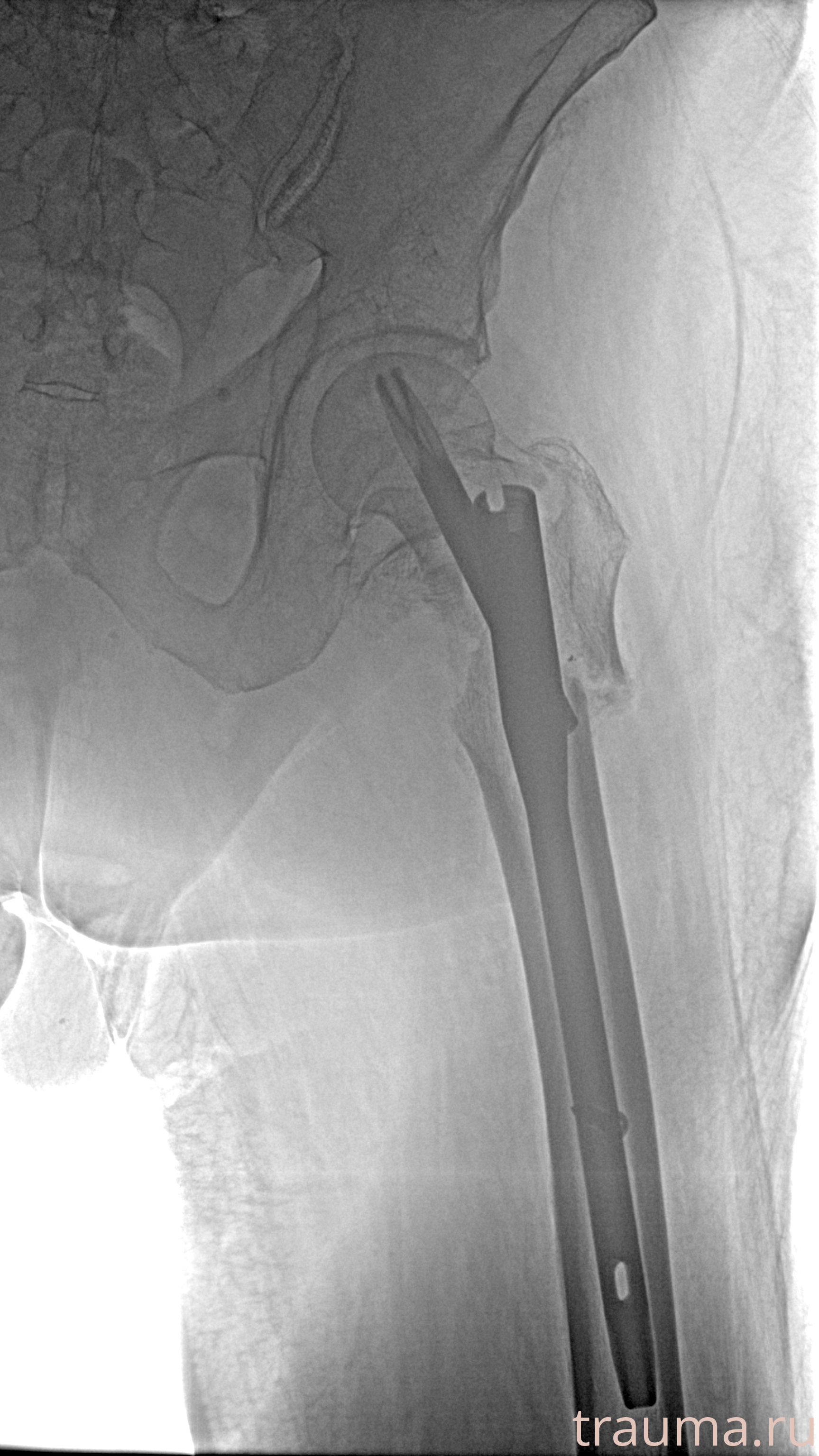 Рентген на дому: по вашему адресу приезжает врач-рентгенолог, травматолог-ортопед с мобильным рентгеновским аппаратом, проводит диагностику травмы или заболевания, делает необходимые рентгенограммы, дает рекомендации по дальнейшему лечению. Получить качественные снимки в домашних условиях возможно благодаря уникальной методике, разработанной МосРентген Центром для института  Склифосовского