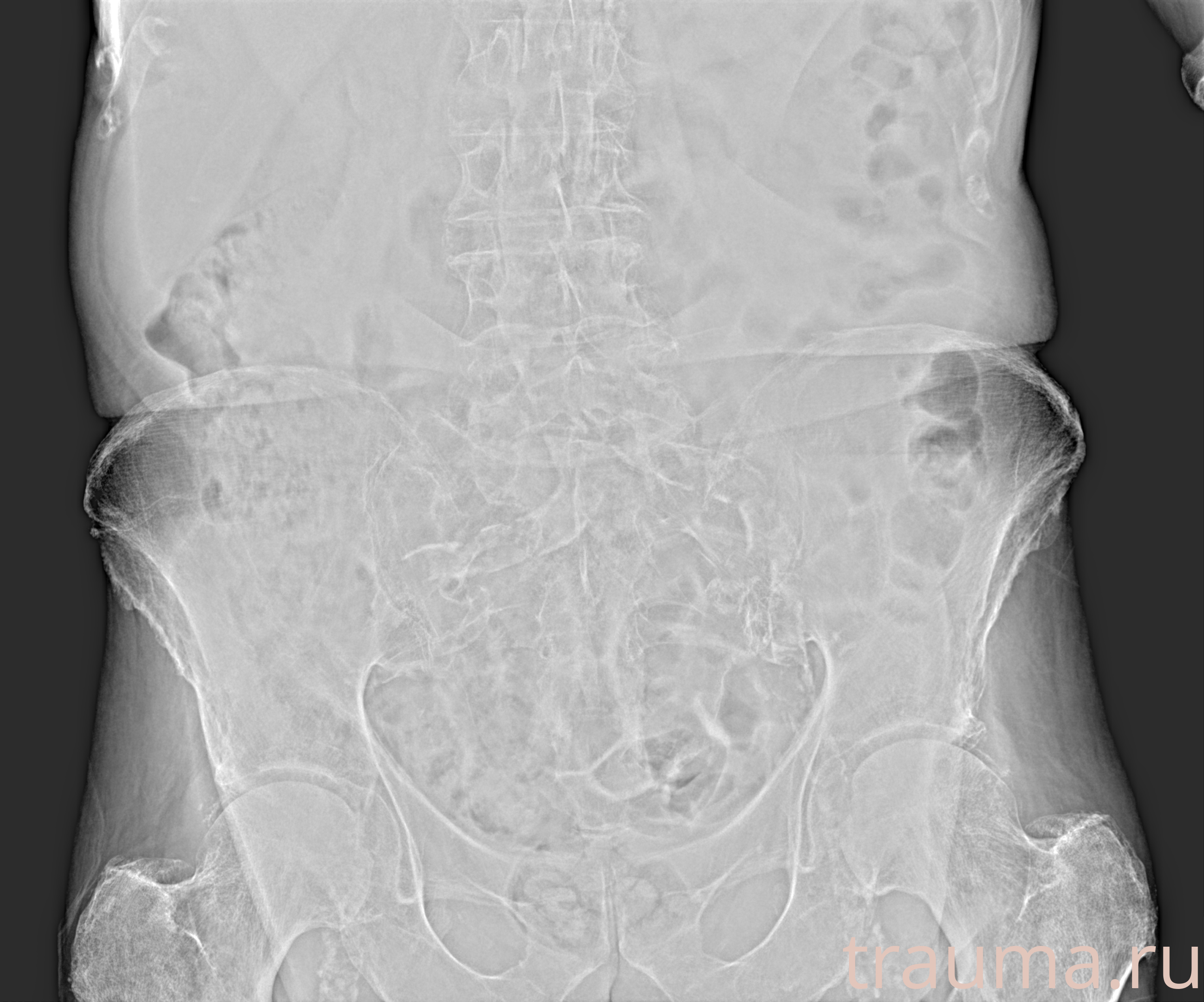 Рентген на дому: по вашему адресу приезжает врач-рентгенолог, травматолог-ортопед с мобильным рентгеновским аппаратом, проводит диагностику травмы или заболевания, делает необходимые рентгенограммы, дает рекомендации по дальнейшему лечению. Получить качественные снимки в домашних условиях возможно благодаря уникальной методике, разработанной МосРентген Центром для института  Склифосовского