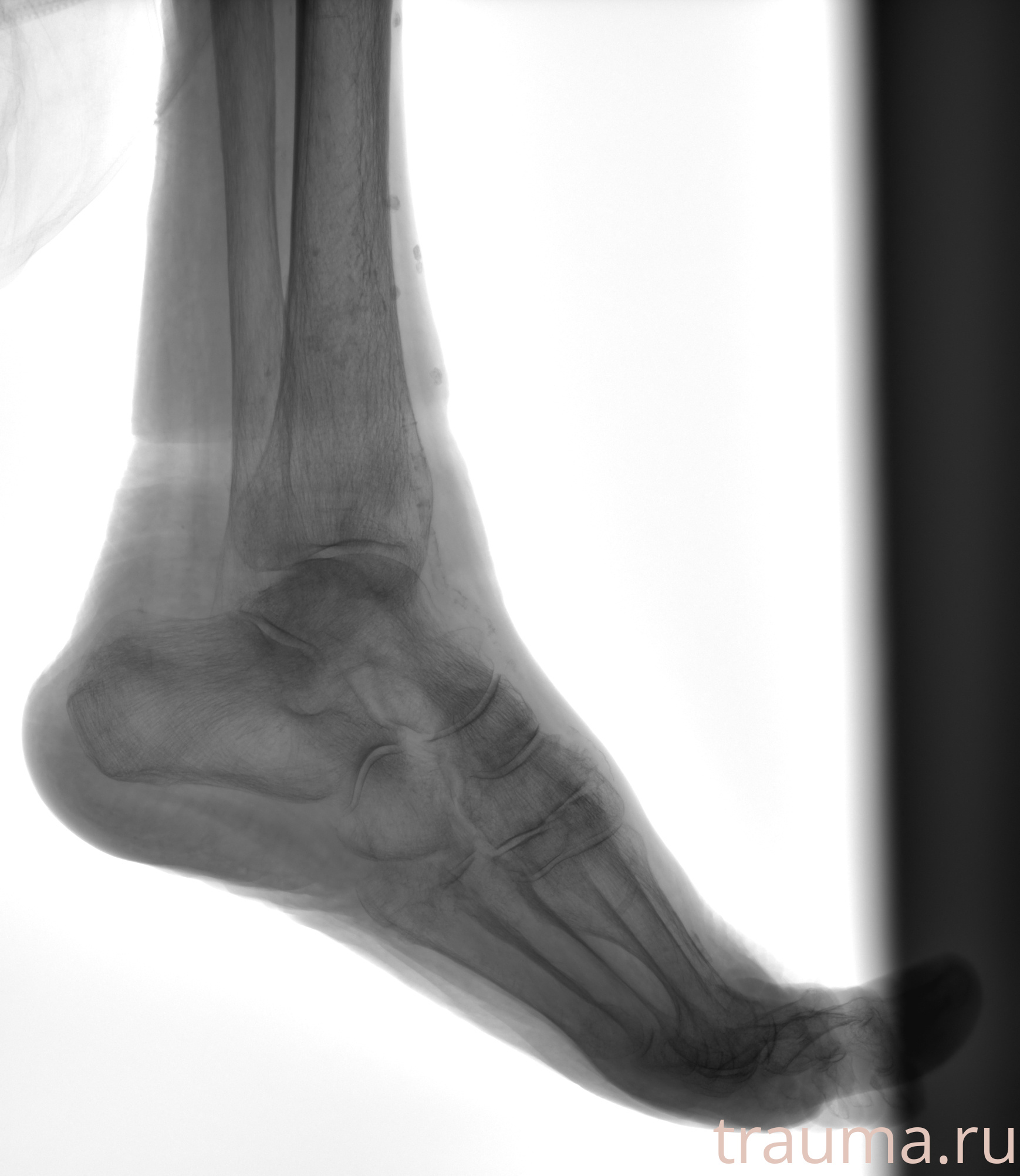 Рентген на дому: по вашему адресу приезжает врач-рентгенолог, травматолог-ортопед с мобильным рентгеновским аппаратом, проводит диагностику травмы или заболевания, делает необходимые рентгенограммы, дает рекомендации по дальнейшему лечению. Получить качественные снимки в домашних условиях возможно благодаря уникальной методике, разработанной МосРентген Центром для института  Склифосовского