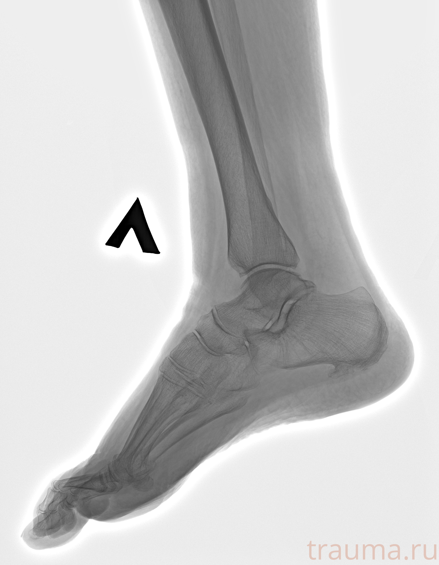 Рентген на дому: по вашему адресу приезжает врач-рентгенолог, травматолог-ортопед с мобильным рентгеновским аппаратом, проводит диагностику травмы или заболевания, делает необходимые рентгенограммы, дает рекомендации по дальнейшему лечению. Получить качественные снимки в домашних условиях возможно благодаря уникальной методике, разработанной МосРентген Центром для института  Склифосовского