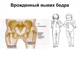 Реконструкция тазобедренного сустава у детей школьного возраста с врожденным вывихом бедра Реконструкция тазобедренного сустава у детей школьного возраста с врожденным вывихом бедра