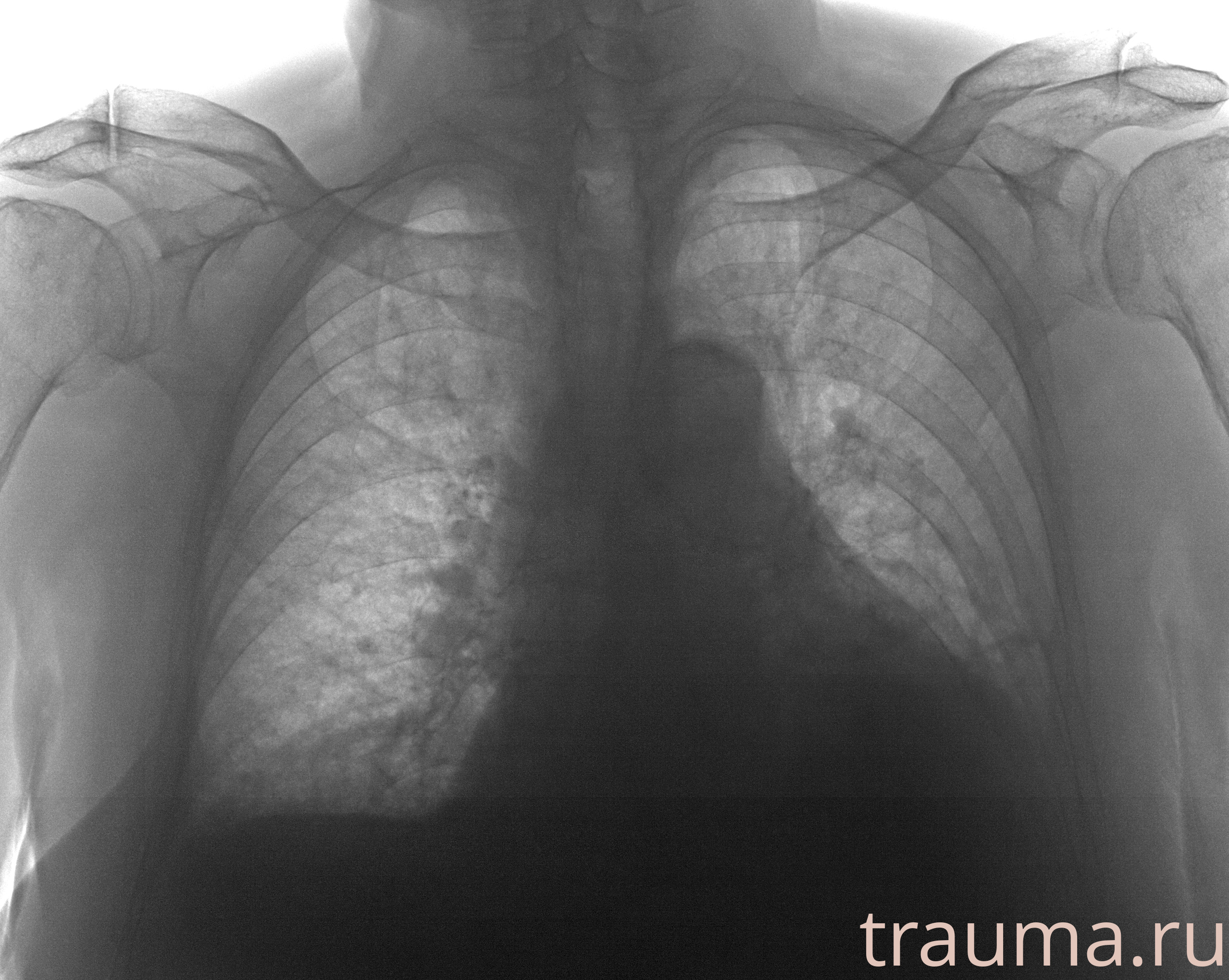 Рентген на дому: по вашему адресу приезжает врач-рентгенолог, травматолог-ортопед с мобильным рентгеновским аппаратом, проводит диагностику травмы или заболевания, делает необходимые рентгенограммы, дает рекомендации по дальнейшему лечению. Получить качественные снимки в домашних условиях возможно благодаря уникальной методике, разработанной МосРентген Центром для института  Склифосовского