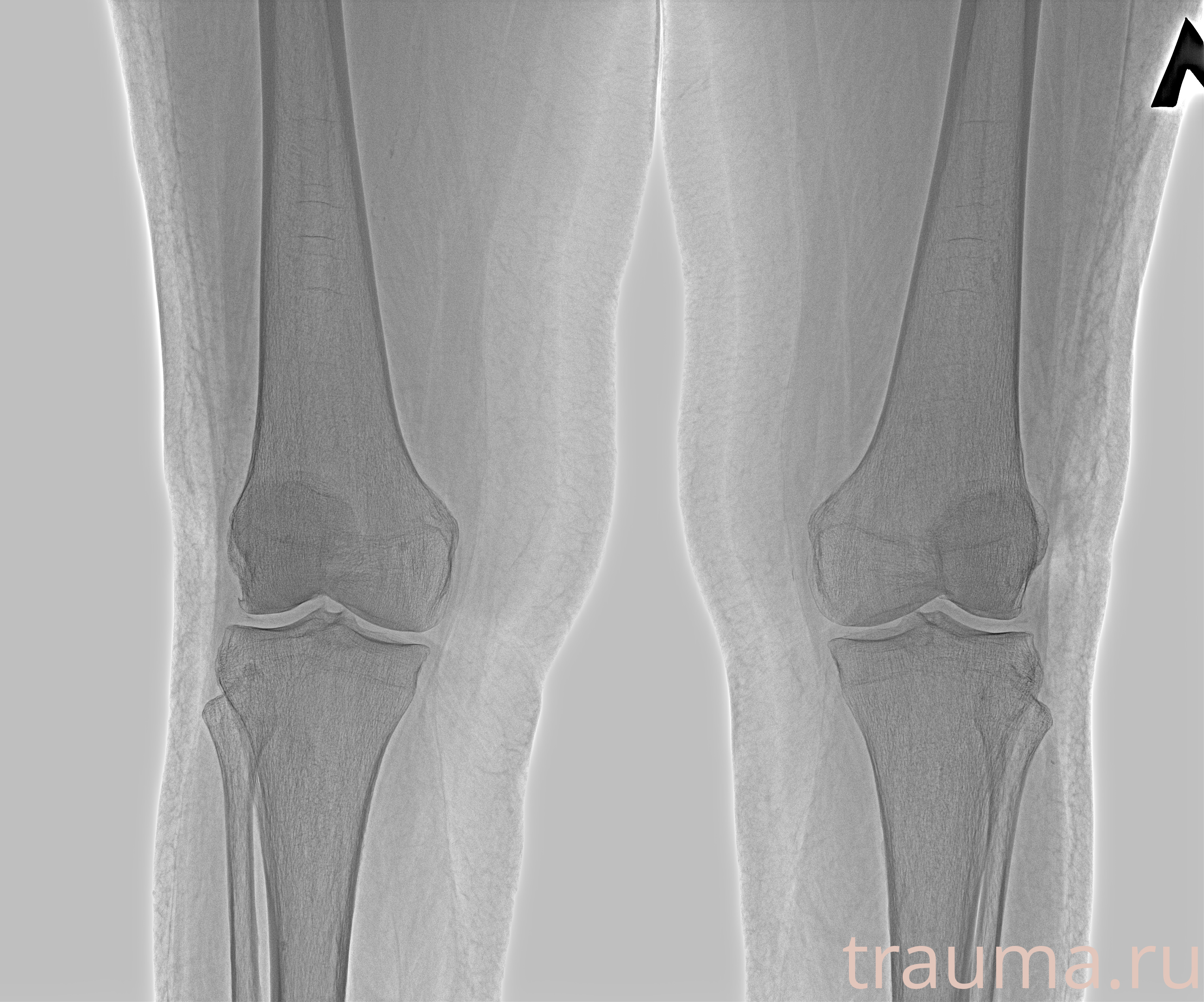 Рентген на дому: по вашему адресу приезжает врач-рентгенолог, травматолог-ортопед с мобильным рентгеновским аппаратом, проводит диагностику травмы или заболевания, делает необходимые рентгенограммы, дает рекомендации по дальнейшему лечению. Получить качественные снимки в домашних условиях возможно благодаря уникальной методике, разработанной МосРентген Центром для института  Склифосовского