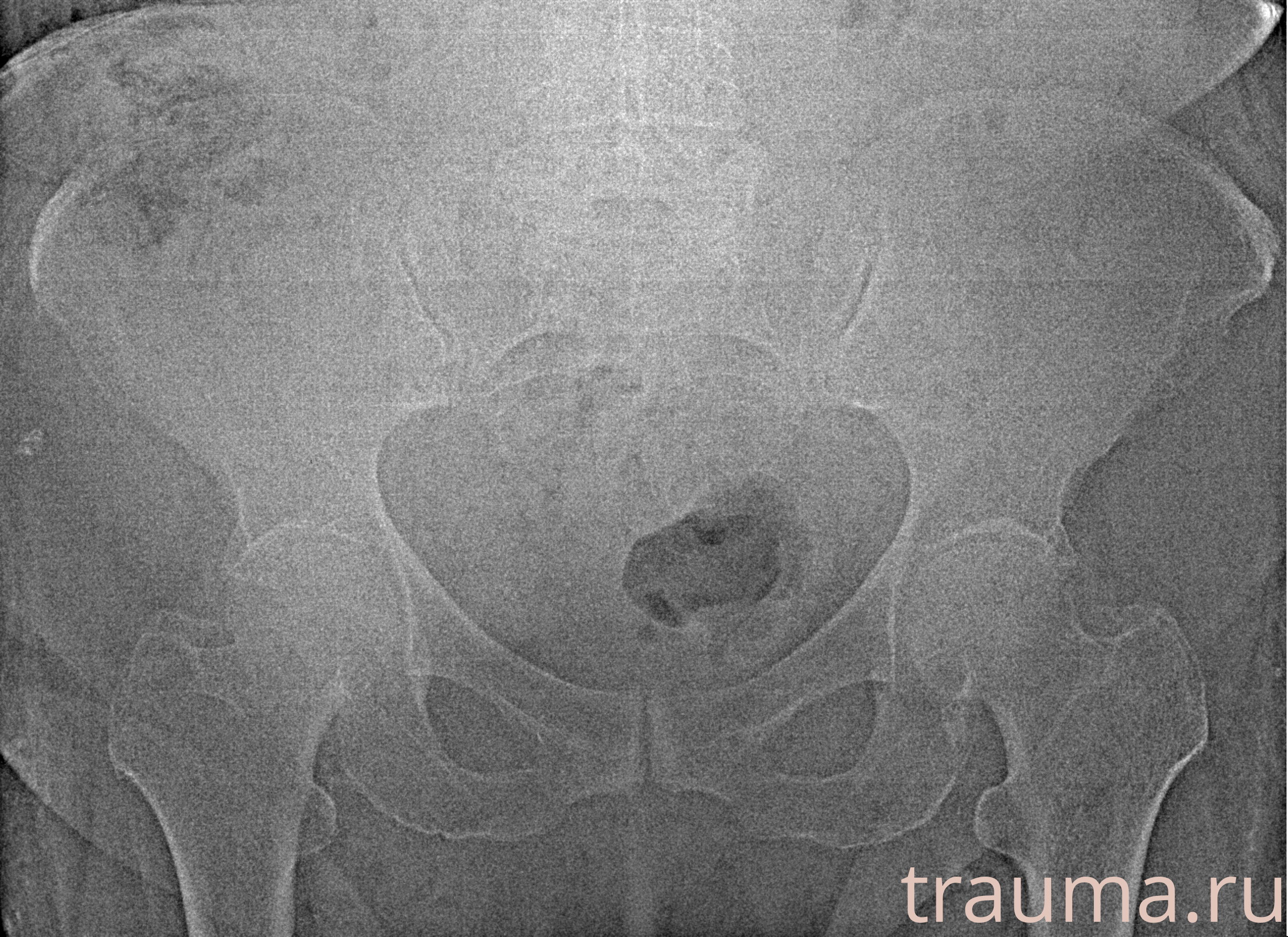 Рентген на дому: по вашему адресу приезжает врач-рентгенолог, травматолог-ортопед с мобильным рентгеновским аппаратом, проводит диагностику травмы или заболевания, делает необходимые рентгенограммы, дает рекомендации по дальнейшему лечению. Получить качественные снимки в домашних условиях возможно благодаря уникальной методике, разработанной МосРентген Центром для института  Склифосовского